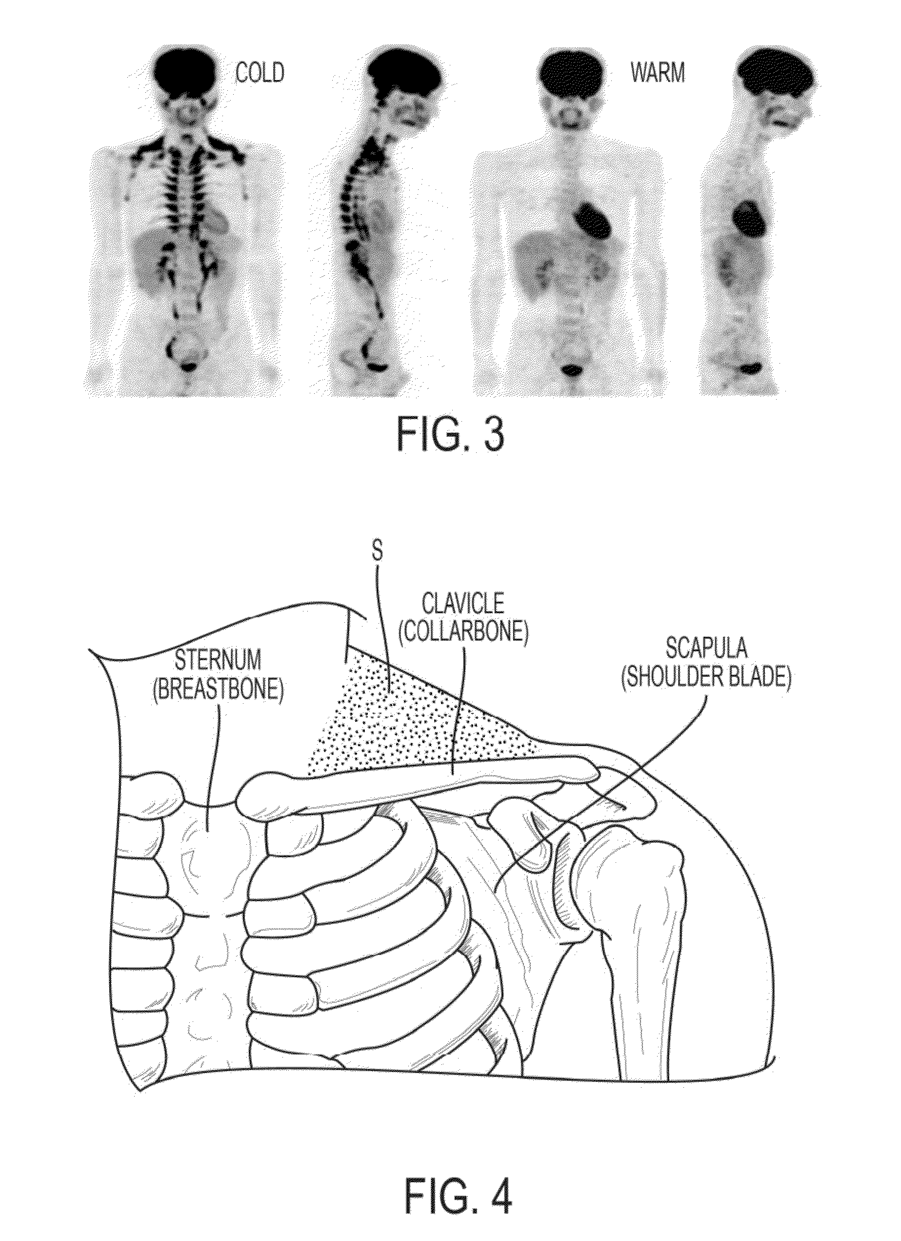 Methods and Devices for Activating Brown Adipose Tissue Using Electrical Energy