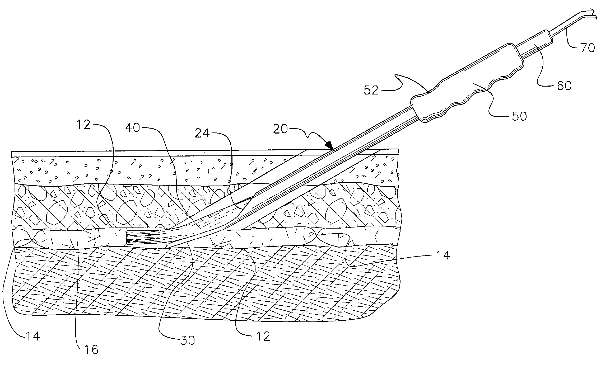 Apparatus for use in fascial cleft surgery for opening an anatomic space