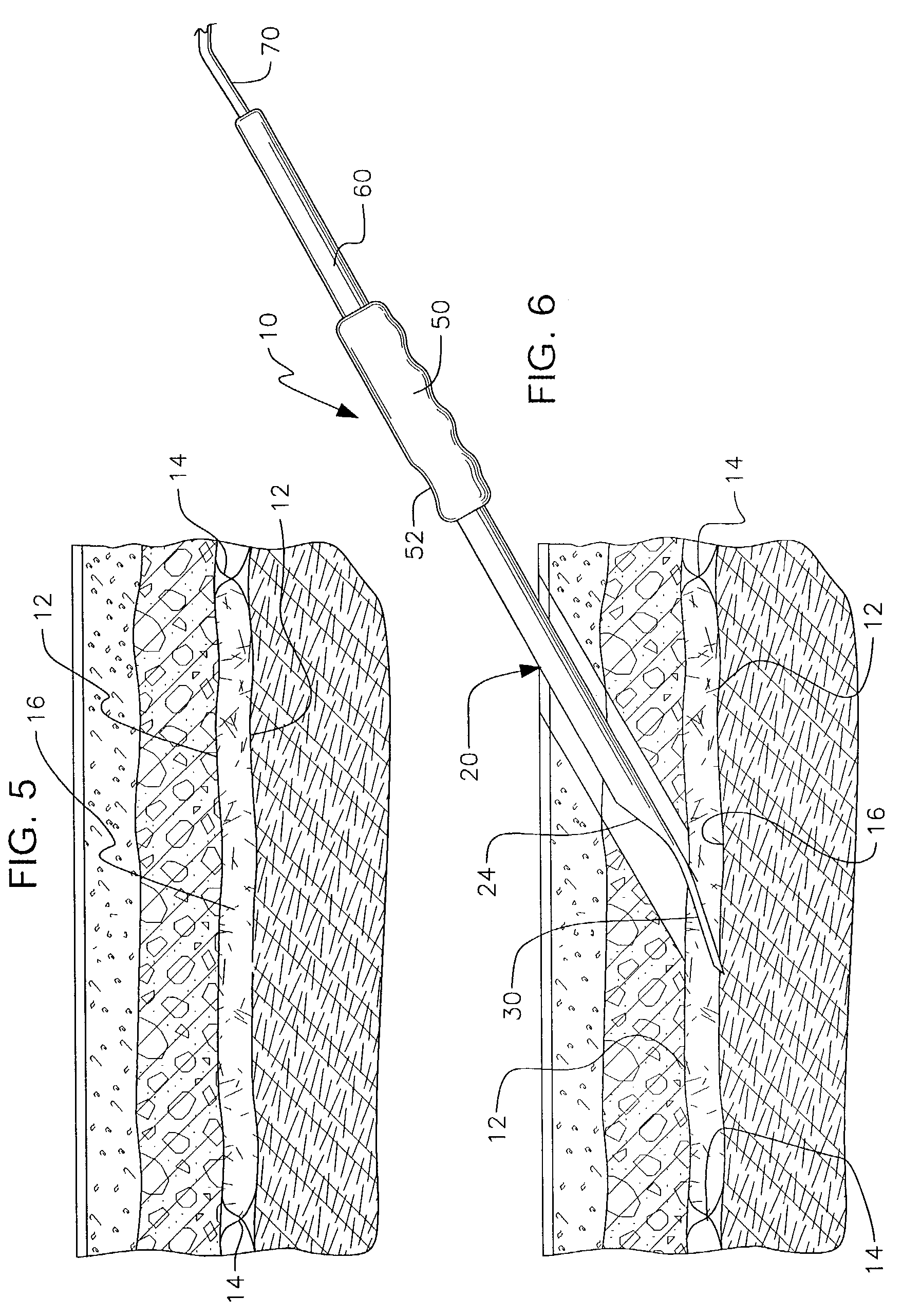 Apparatus for use in fascial cleft surgery for opening an anatomic space