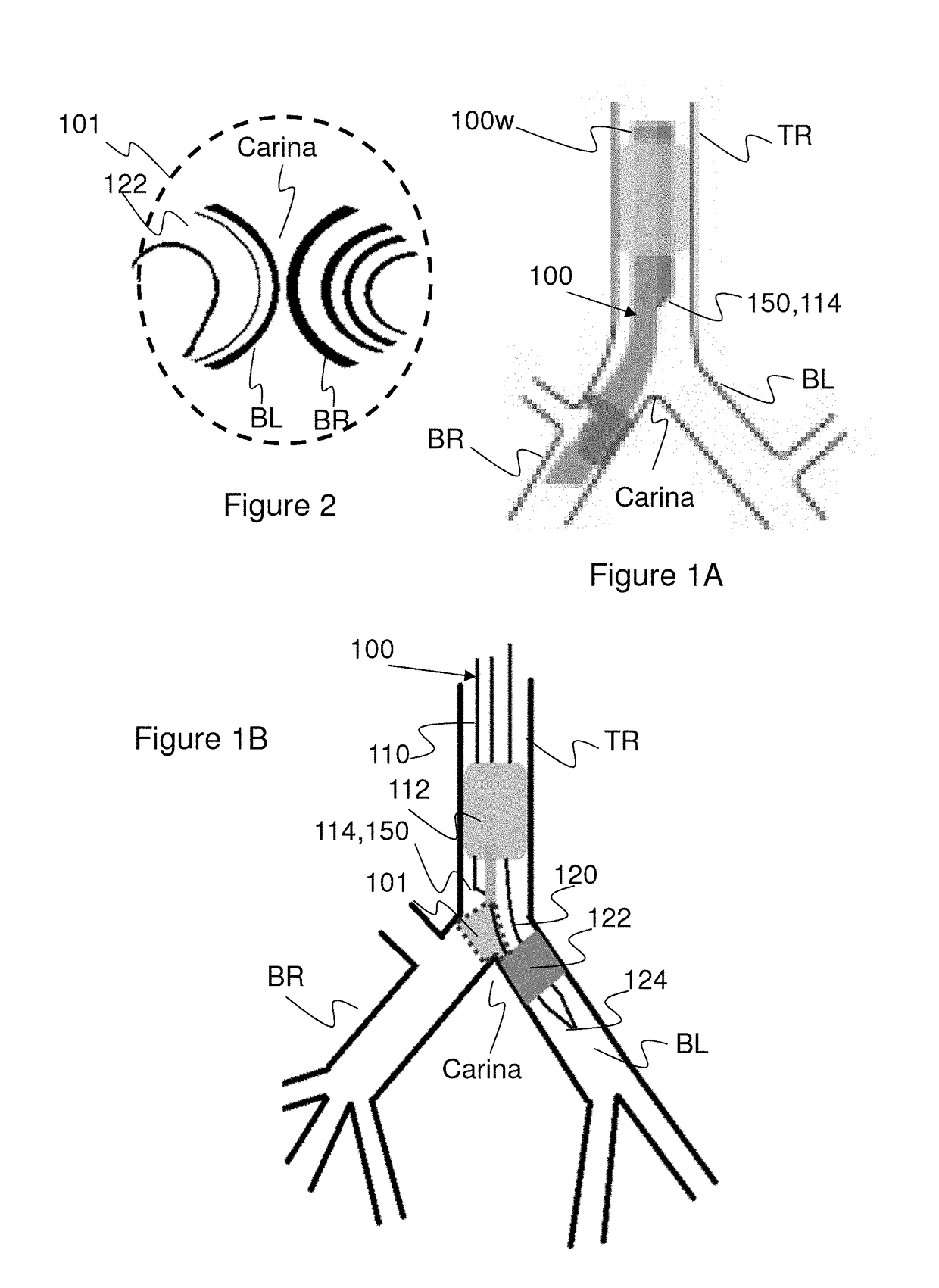 Endobronchial tube with integrated image sensor and a cleaning nozzle arrangement