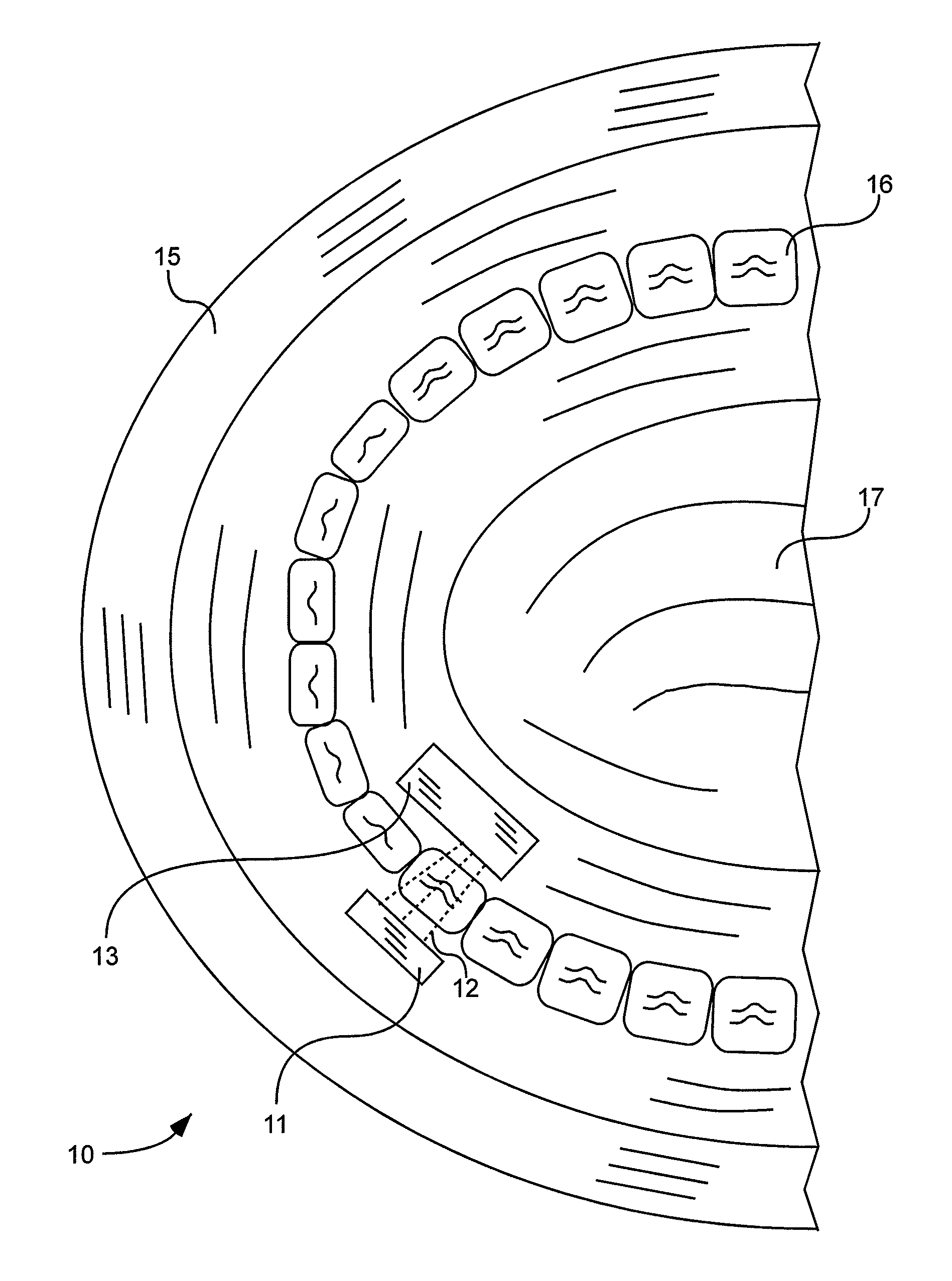 X-ray tube and receiver inside mouth