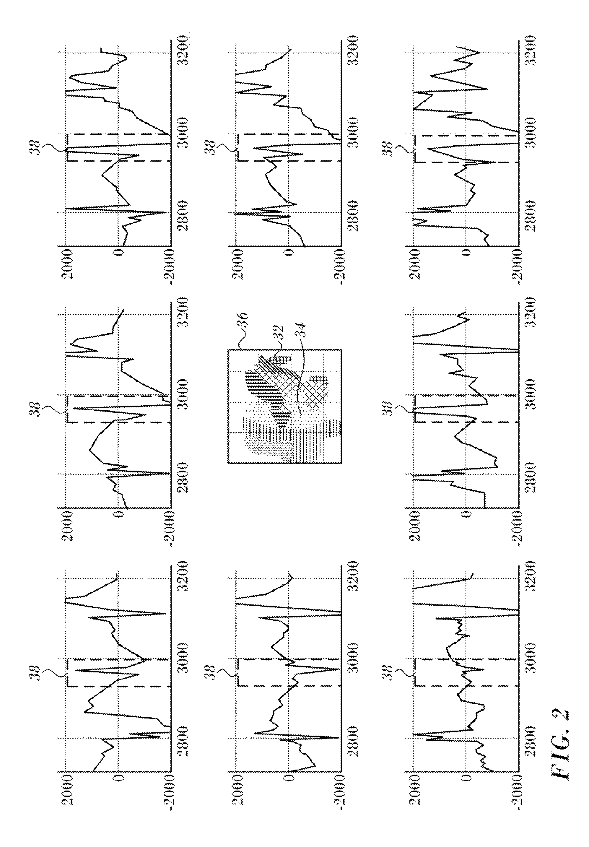 Double bipolar configuration for atrial fibrillation annotation