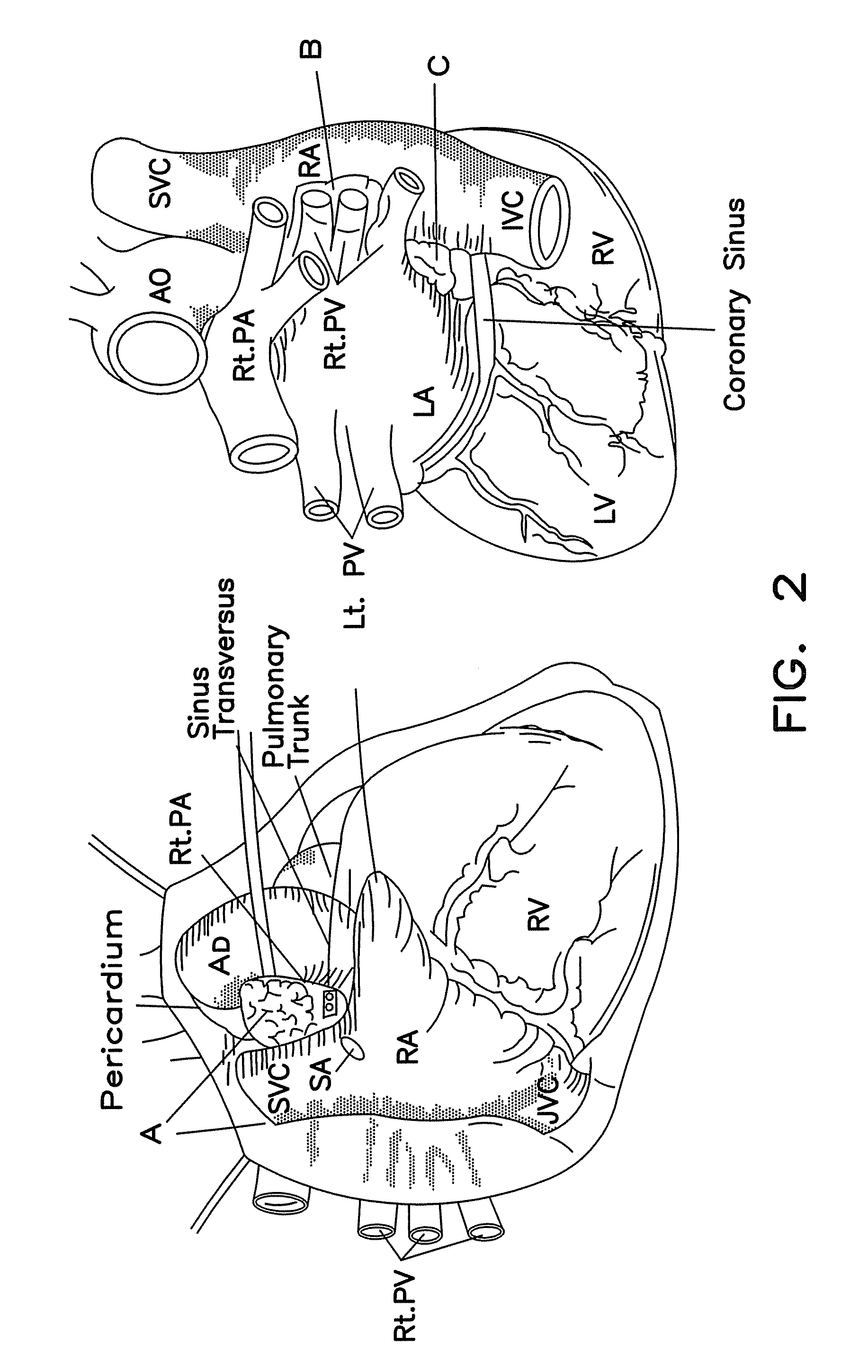 Method for arrhythmias treatment based on spectral mapping during sinus rhythm