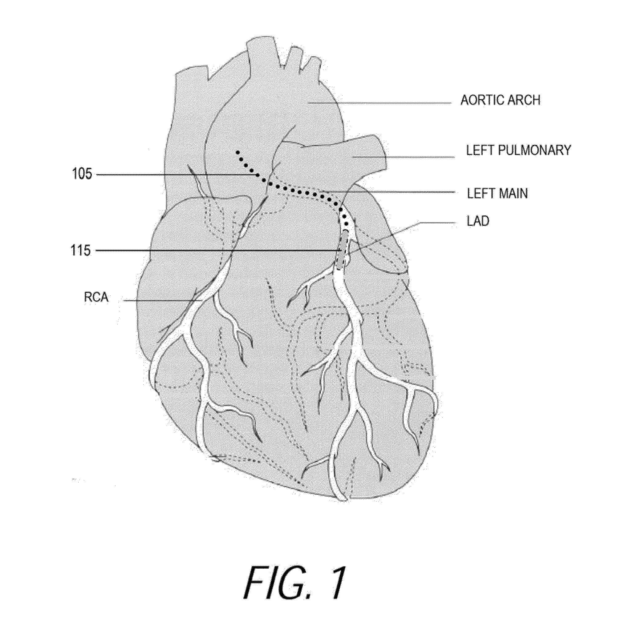 Medical probes for the treatment of blood vessels