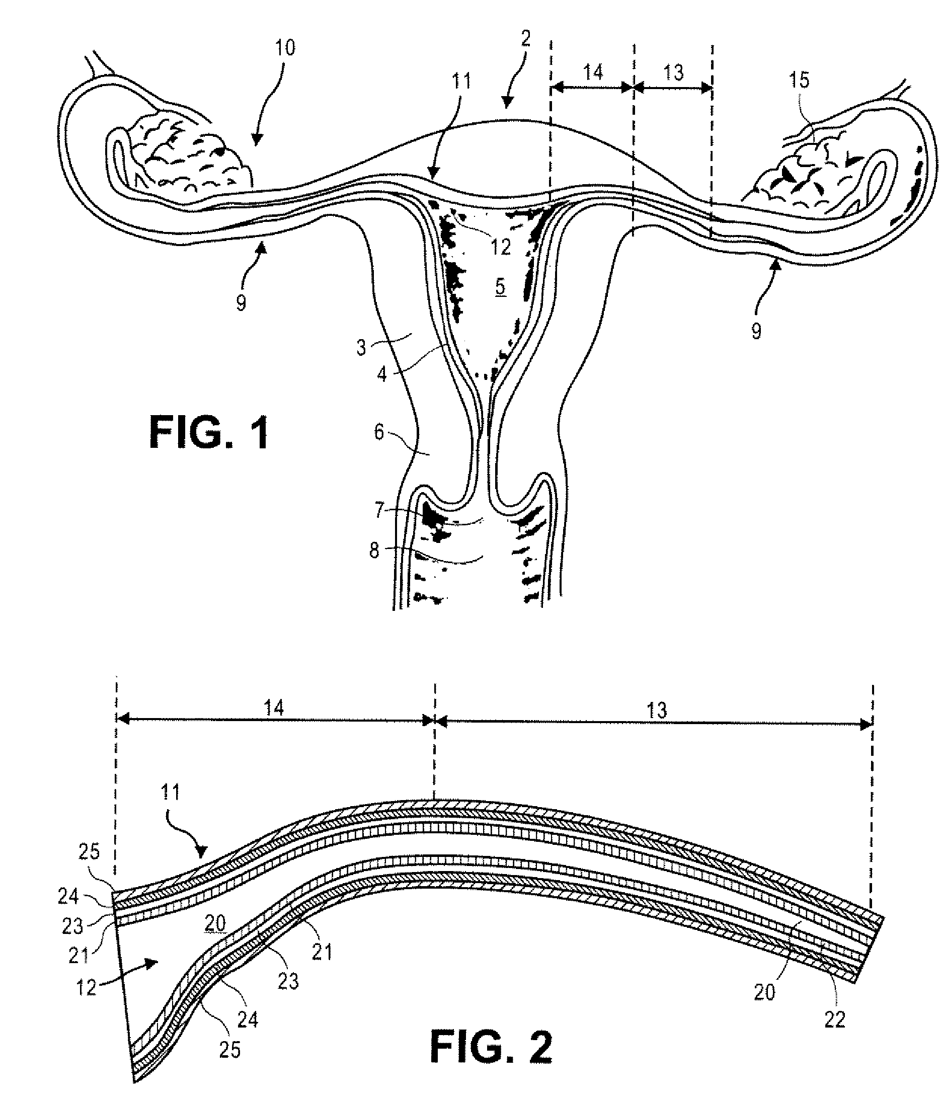 Methods and devices for occluding an ovarian pathway