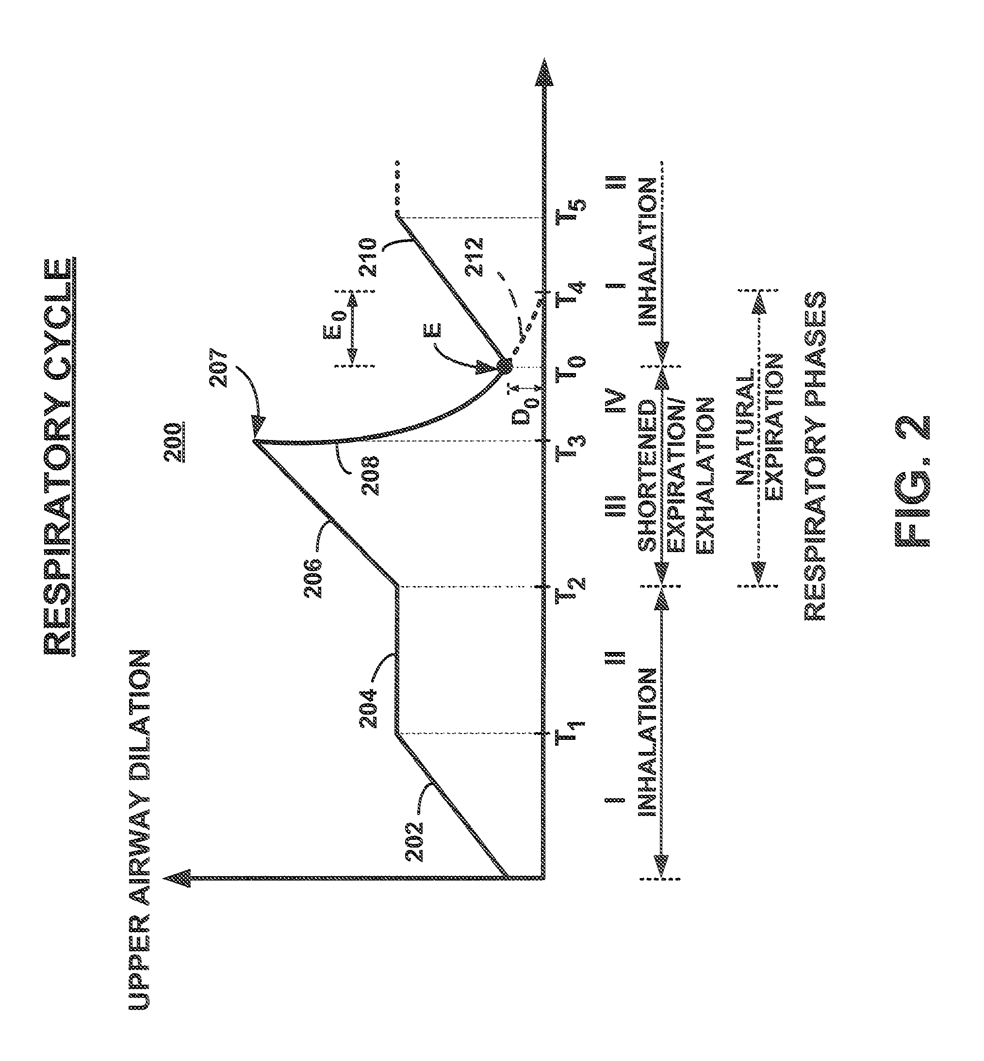 Discontinuous Positive Airway Pressure Device And Method Of Reducing Sleep Disordered Breathing Events