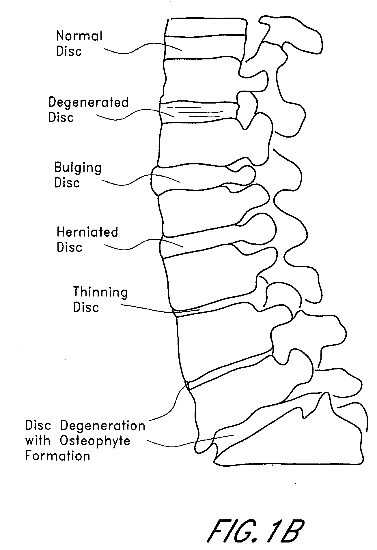 Bone dilator system