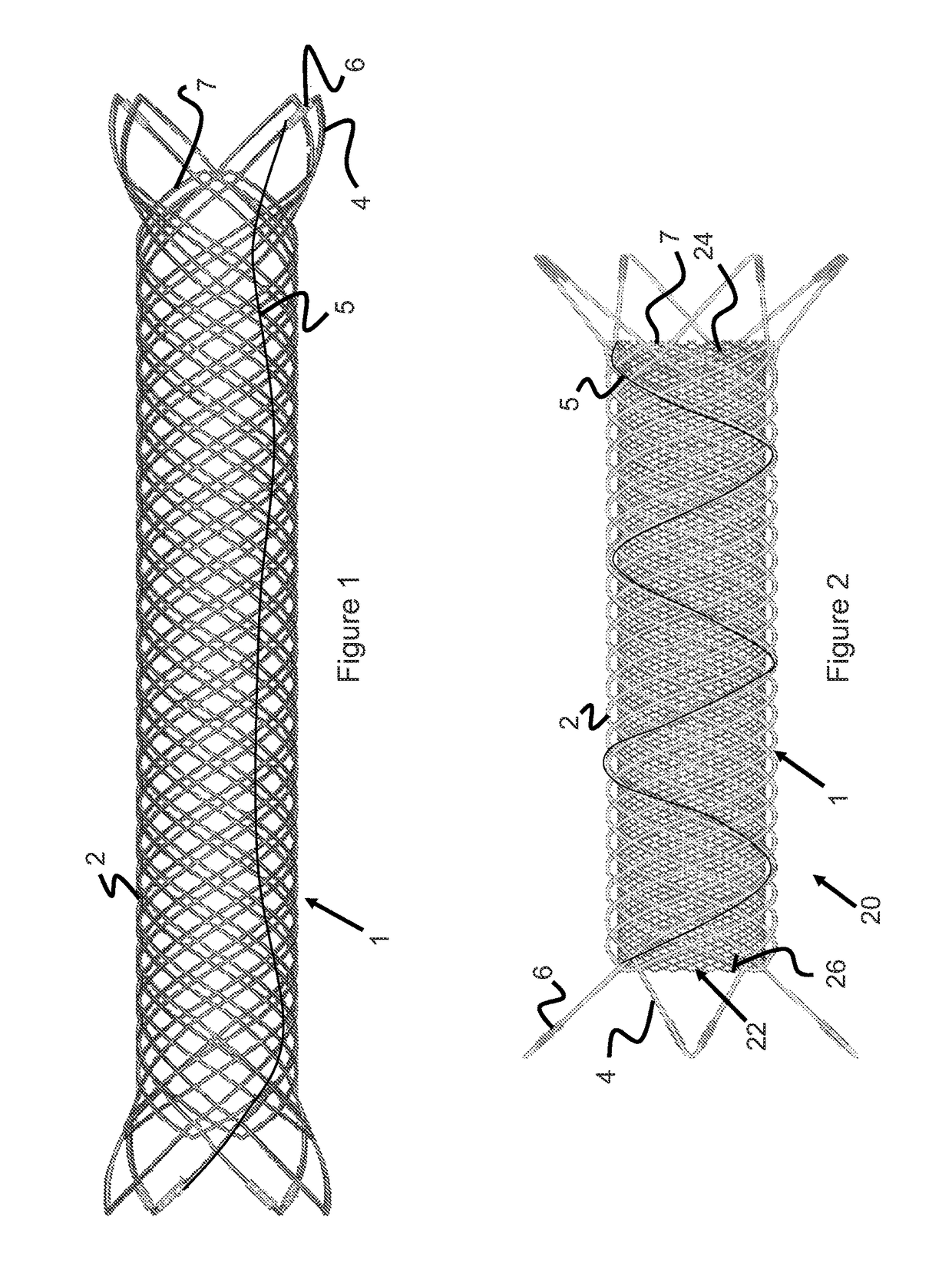 Implant Retention, Detachment, And Delivery System