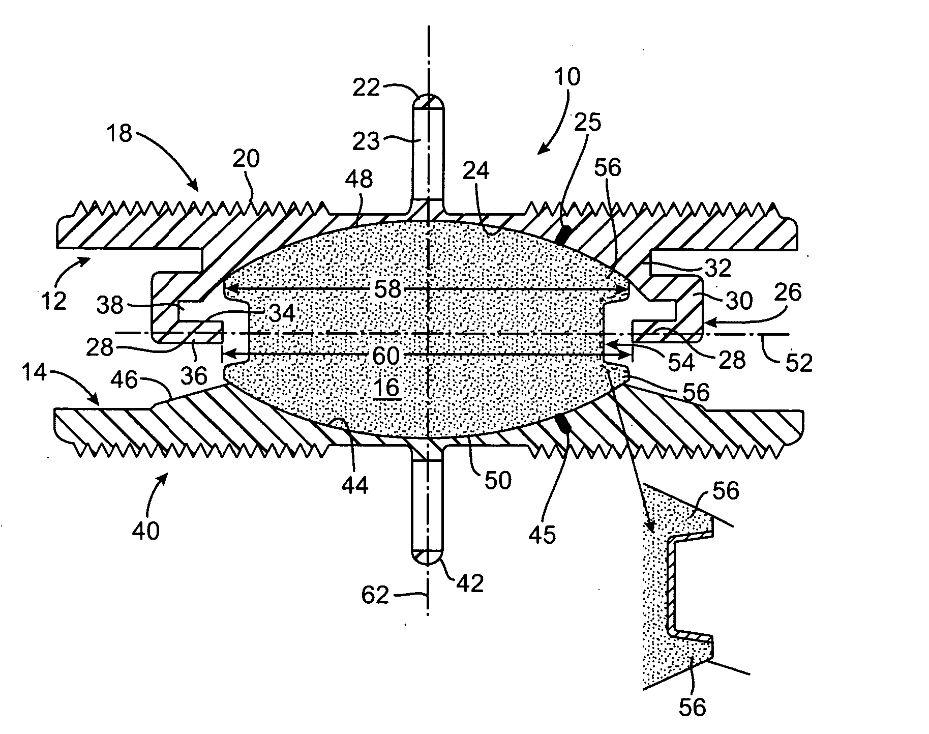 Intervertebral Prosthetic Disc With Metallic Core