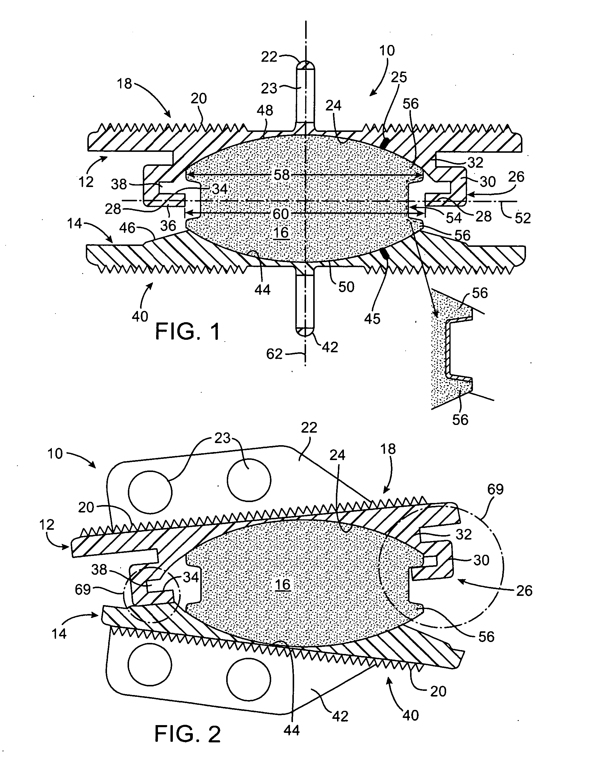 Intervertebral Prosthetic Disc With Metallic Core