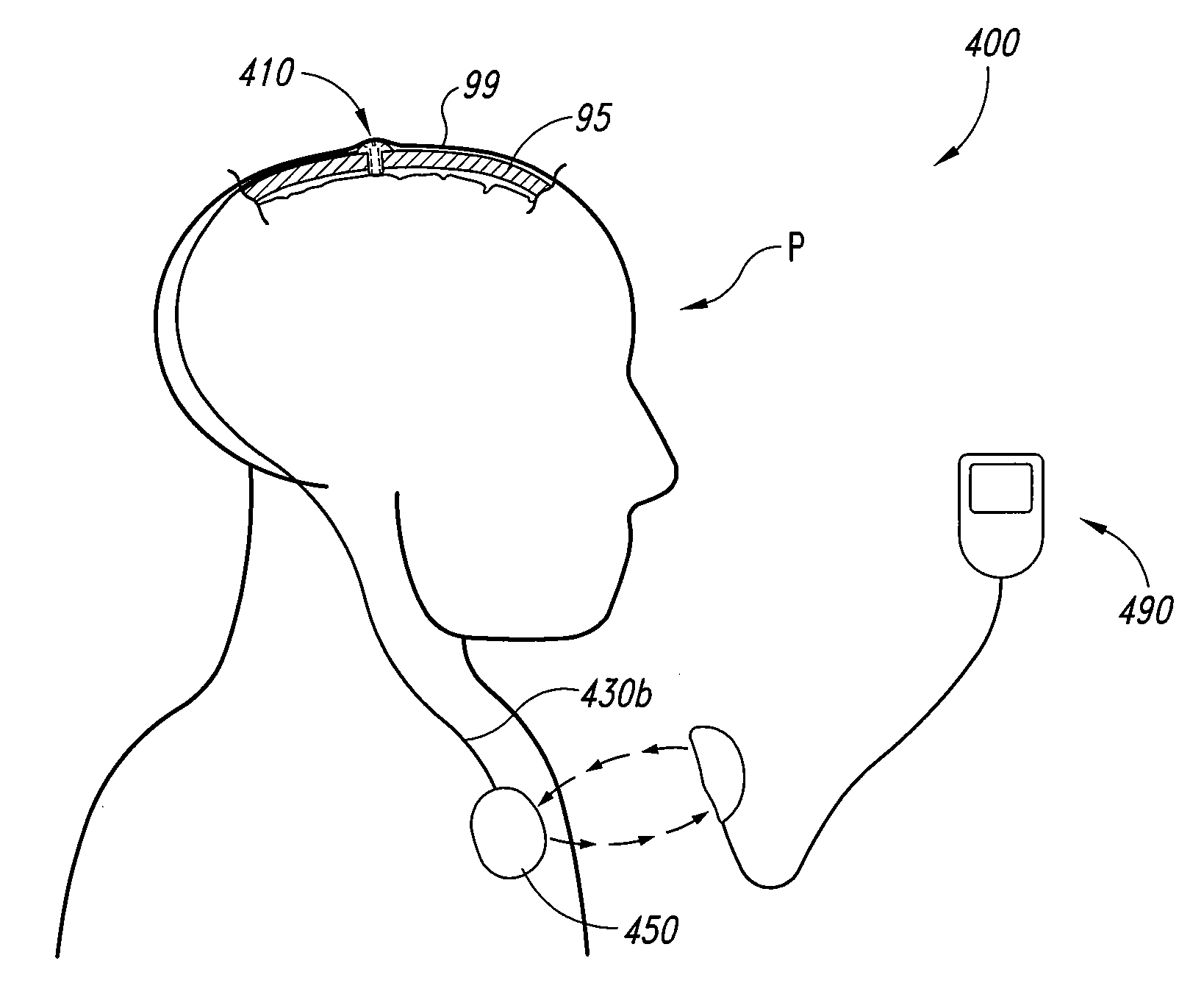 Electrode configurations for reducing invasiveness and/or enhancing neural stimulation efficacy, and associated methods
