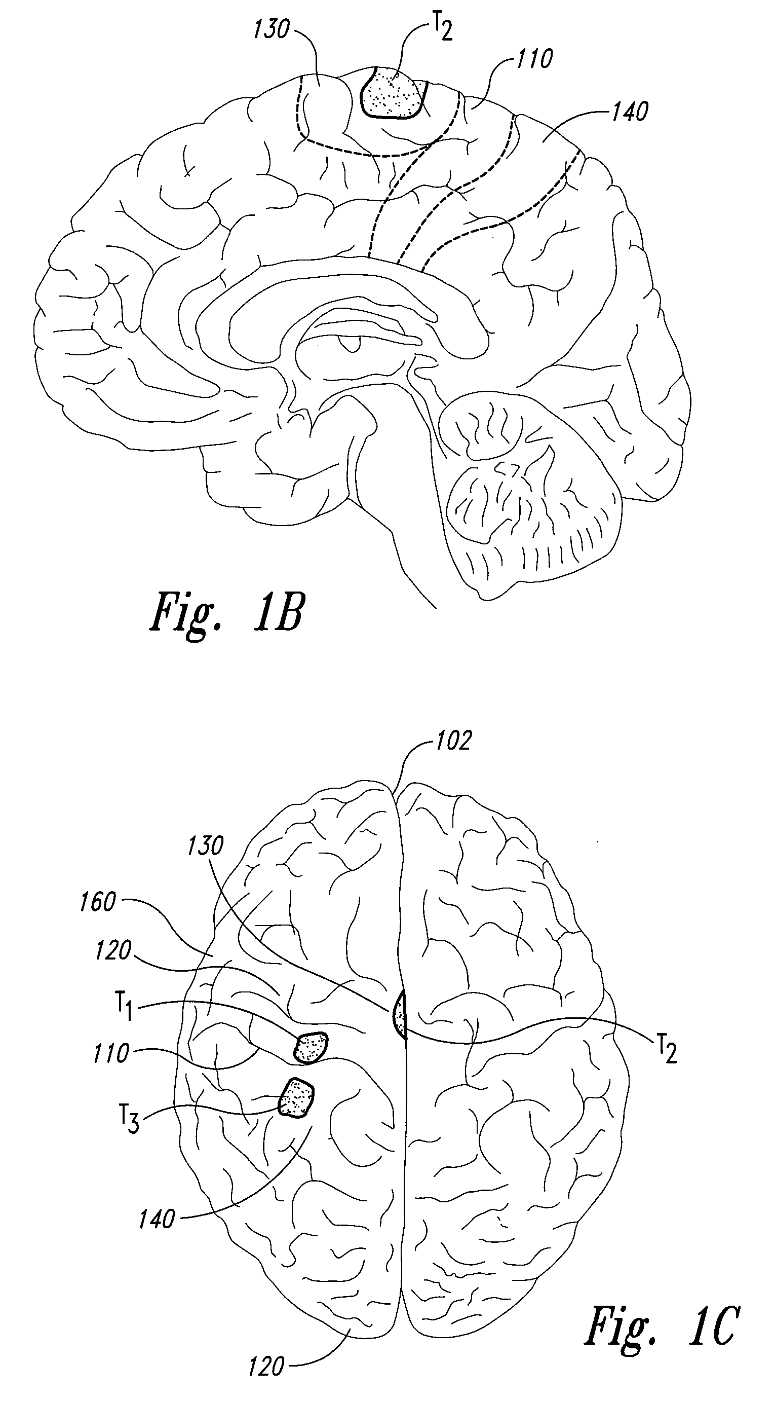 Electrode configurations for reducing invasiveness and/or enhancing neural stimulation efficacy, and associated methods