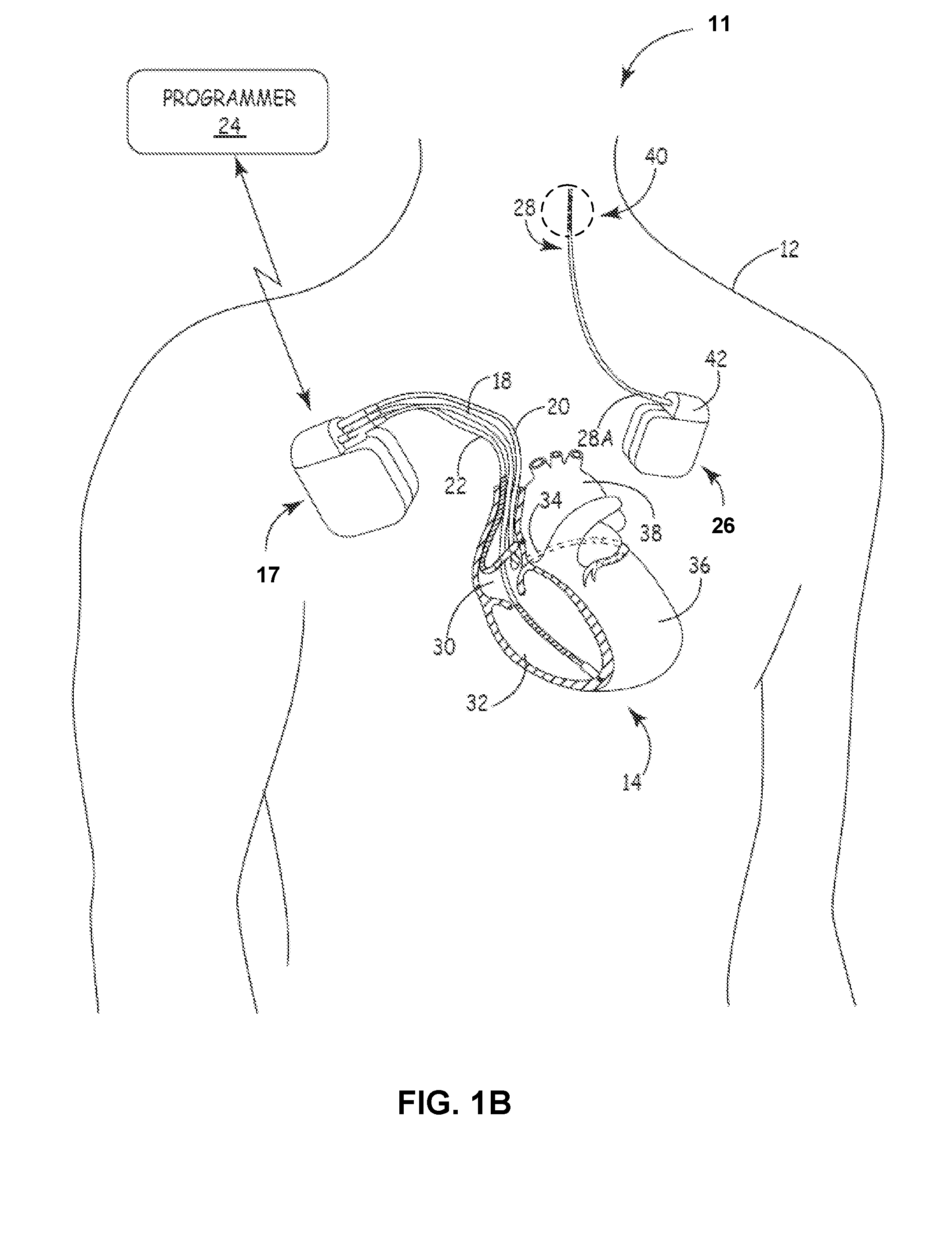 Techniques for placing medical leads for electrical stimulation of nerve tissue