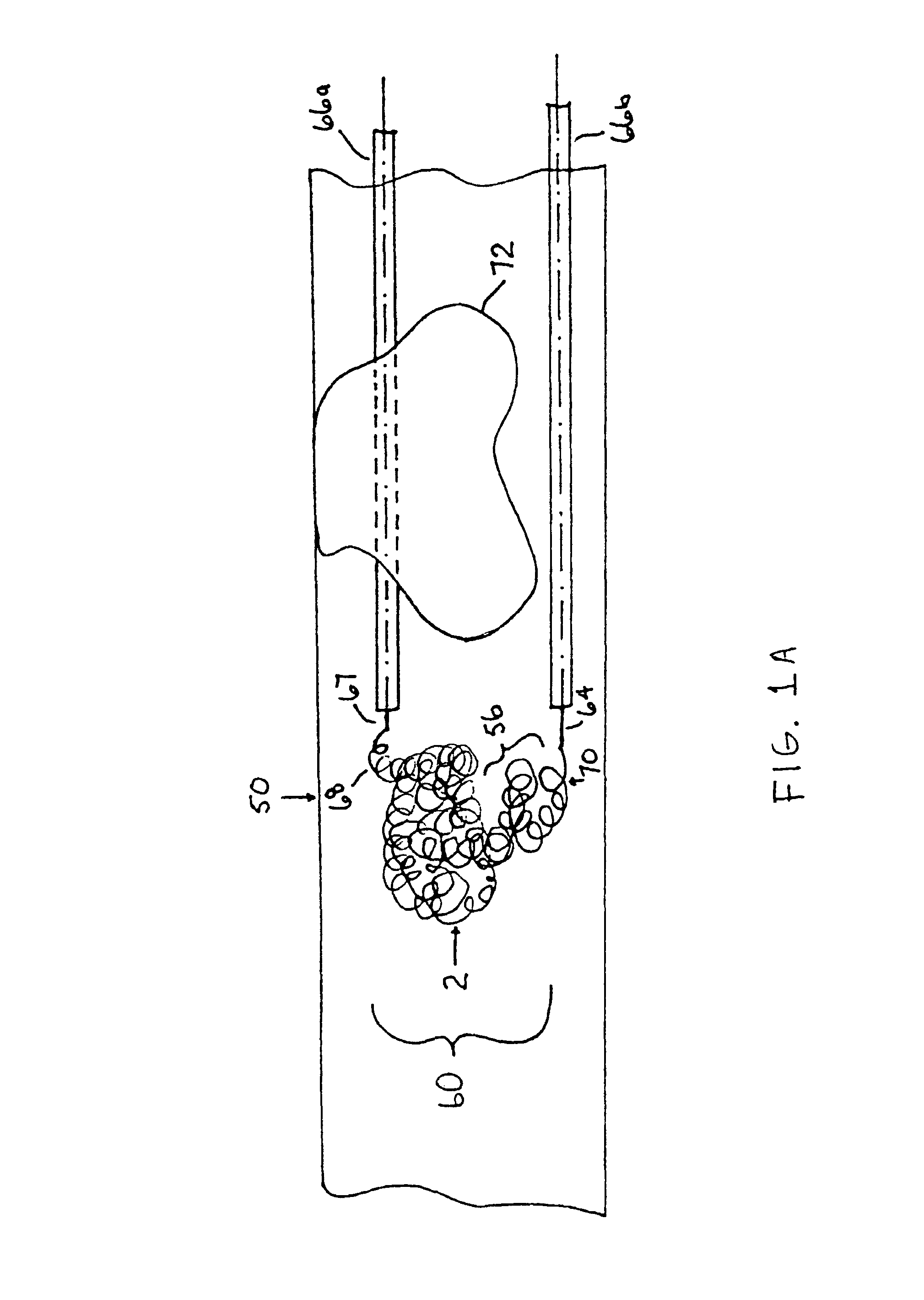 Thrombus removal system and process