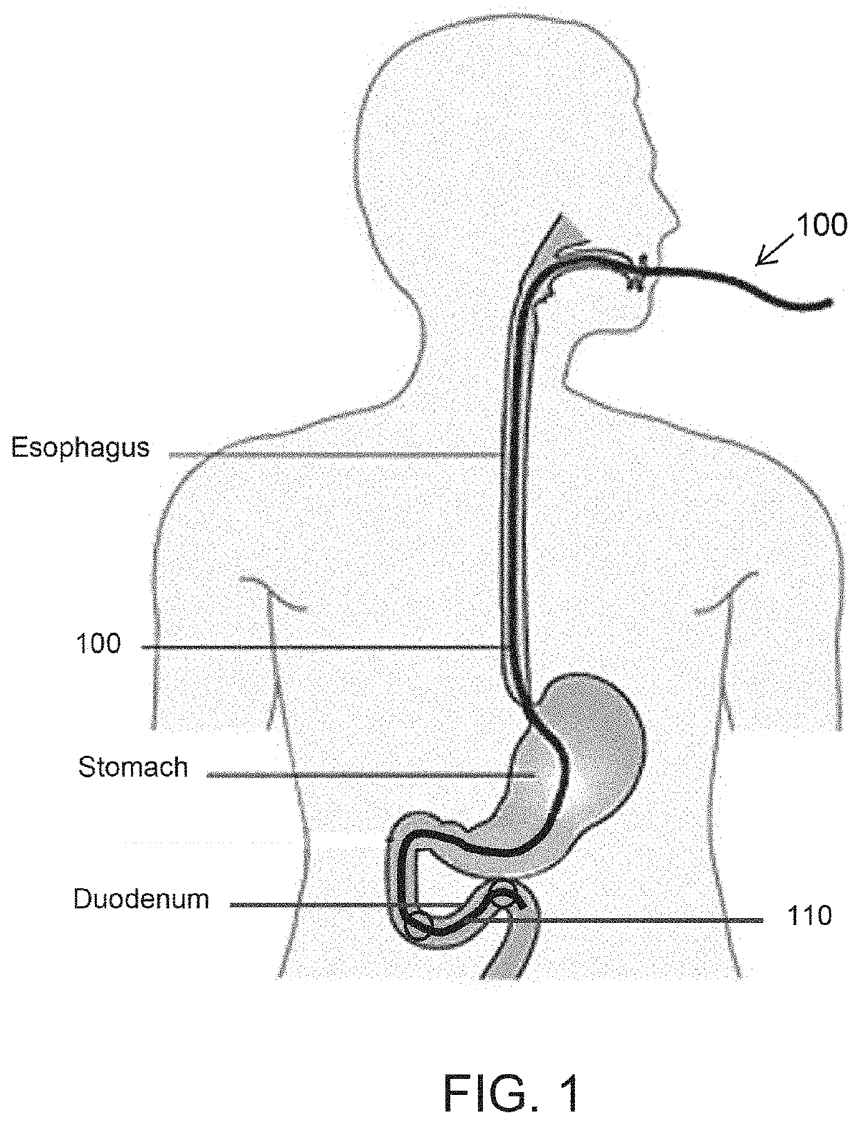 Diabetes Treatment Methods and Devices