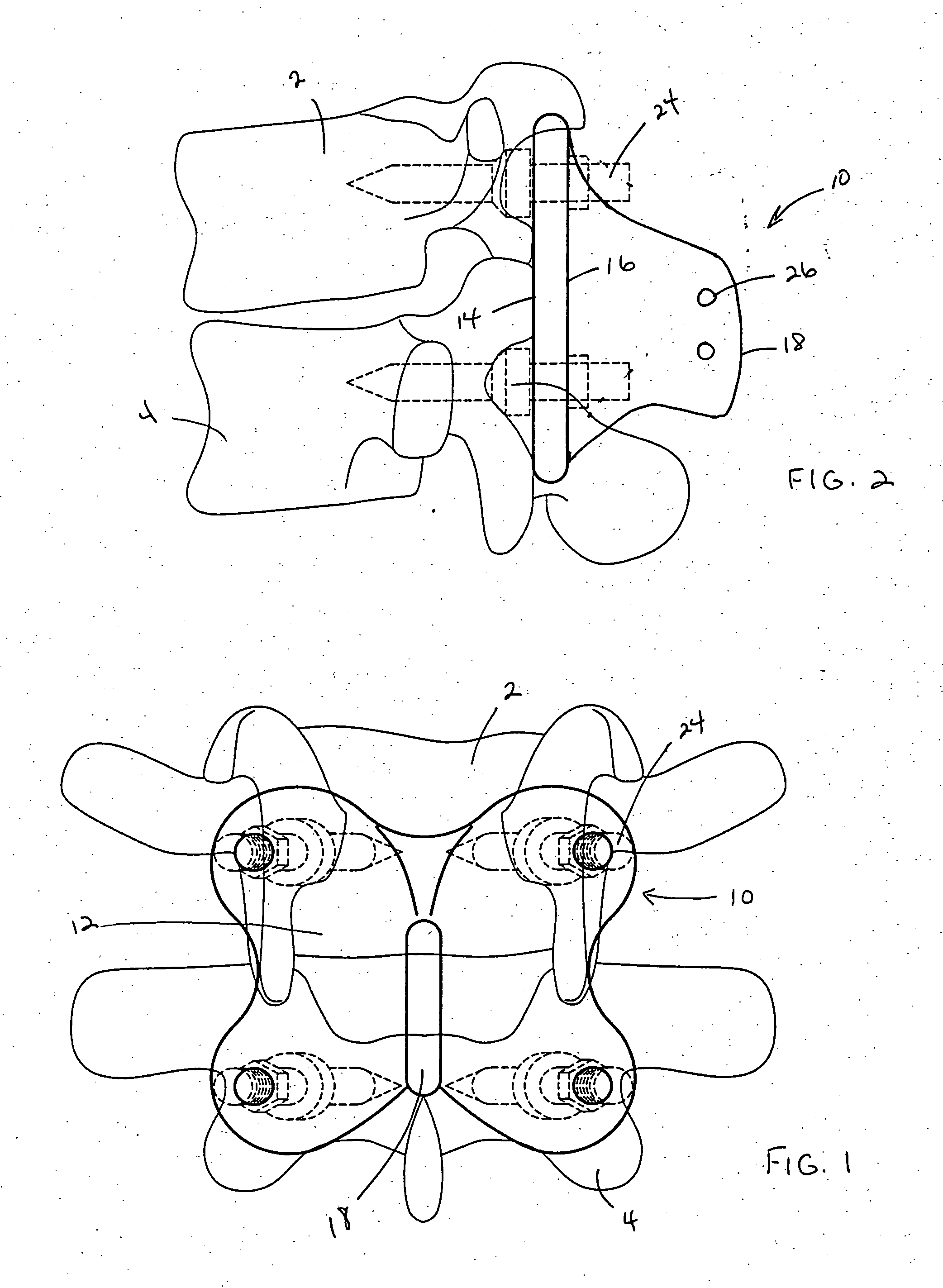 Spinal implant device