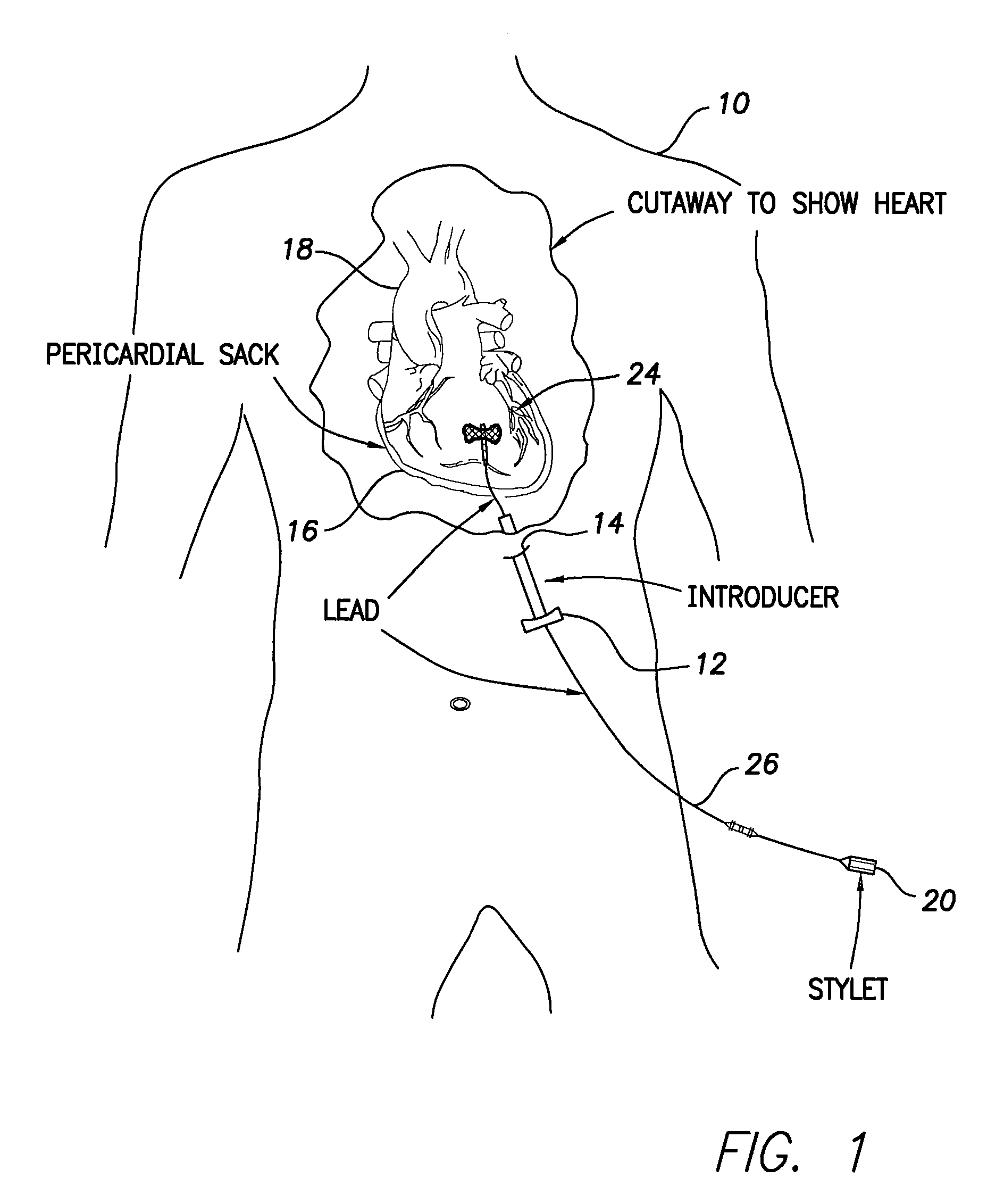 Passive fixation mechanism for epicardial sensing and stimulation lead placed through pericardial access