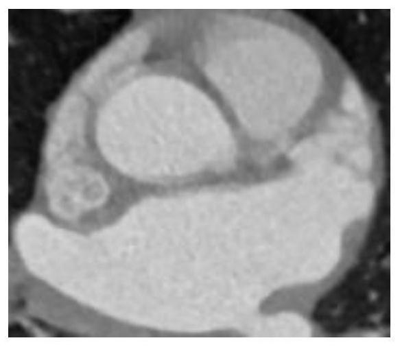 A Segmentation Method of CT Image of Left Atrial Appendage