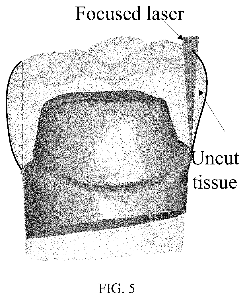Peeling type laser tooth preparing method, apparatus and device, and medium