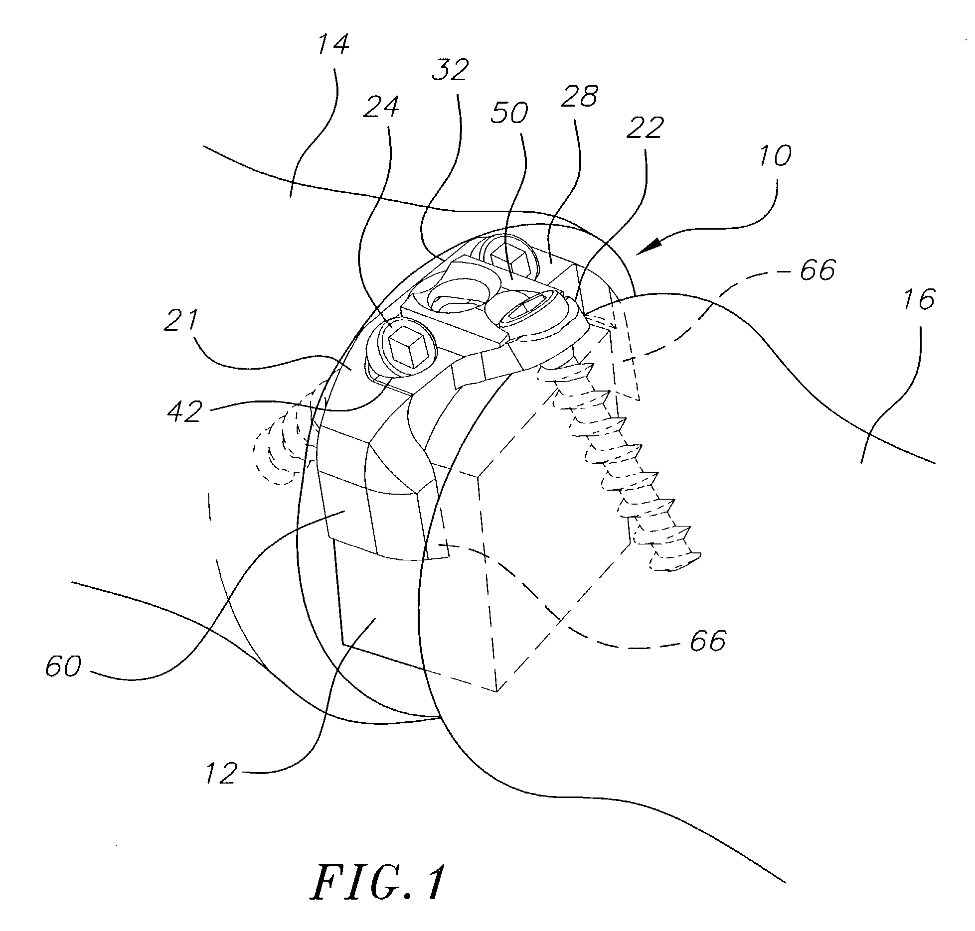 Bone plate stabilization system and method for its use