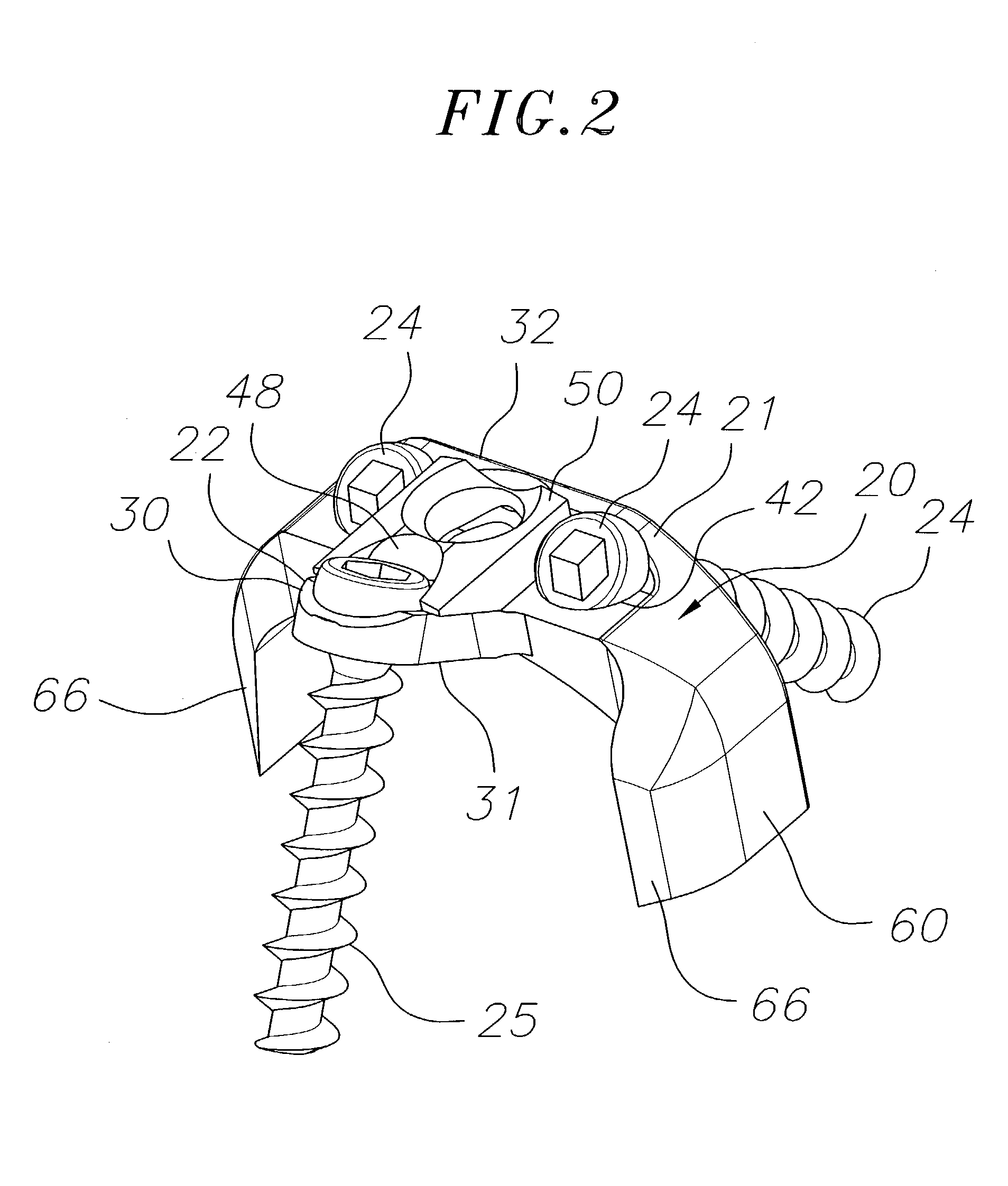 Bone plate stabilization system and method for its use
