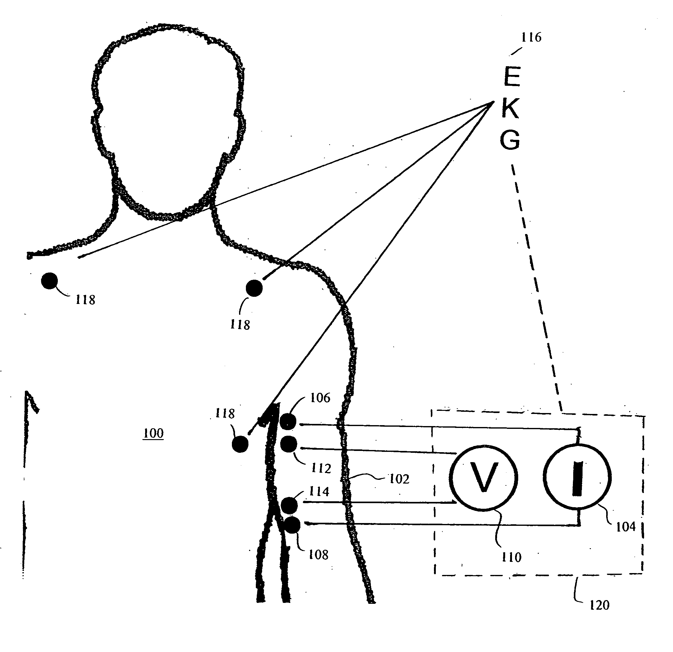 Apparatus and method for determination of stroke volume using the brachial artery