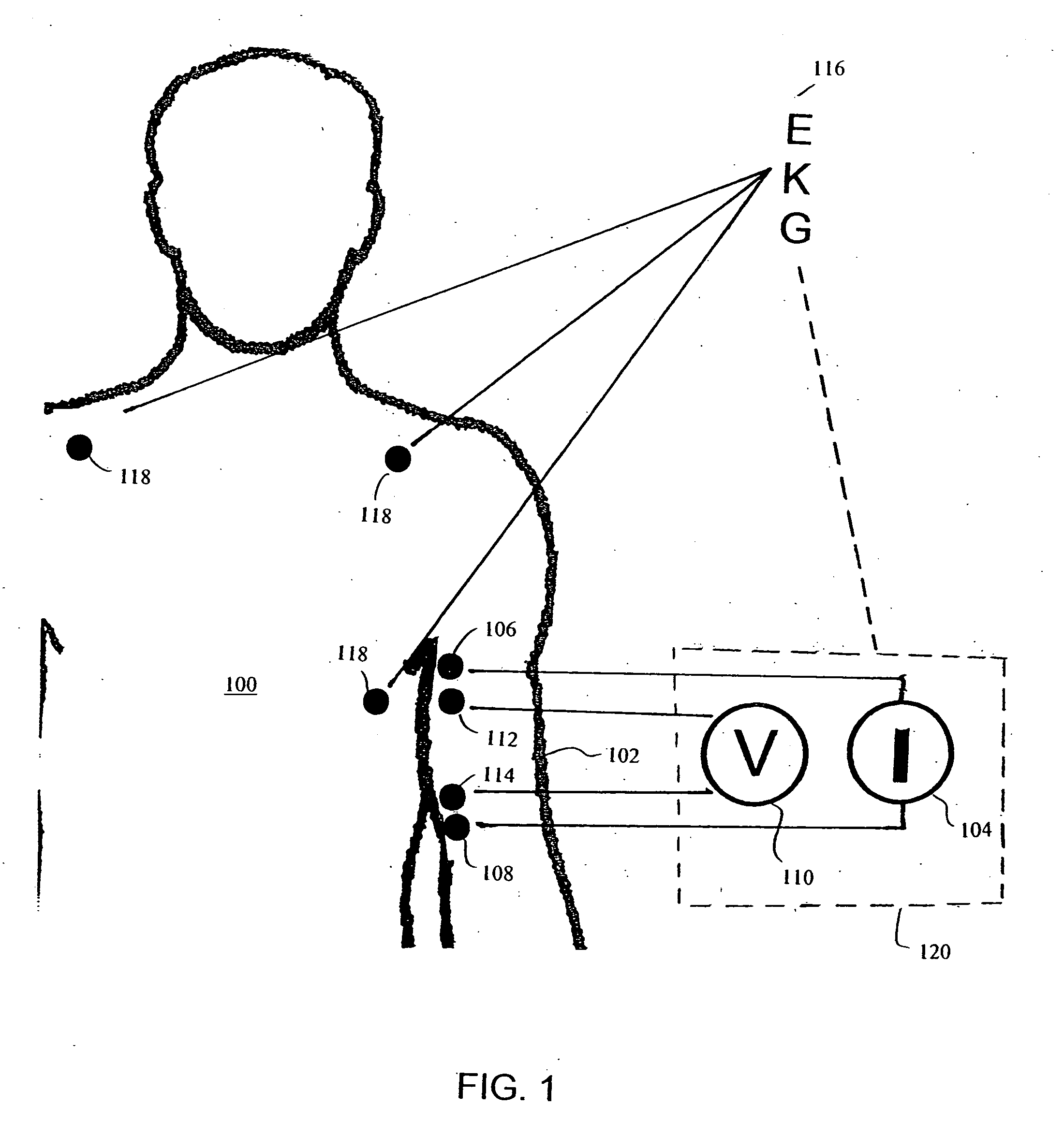 Apparatus and method for determination of stroke volume using the brachial artery