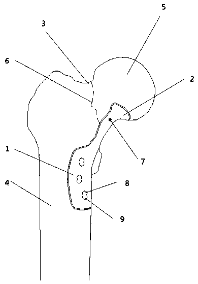 Internal fixation anti-slip locking bone fracture plate applied to femoral neck fracture