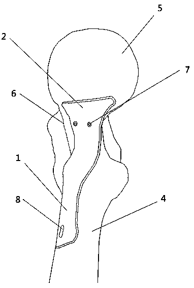 Internal fixation anti-slip locking bone fracture plate applied to femoral neck fracture