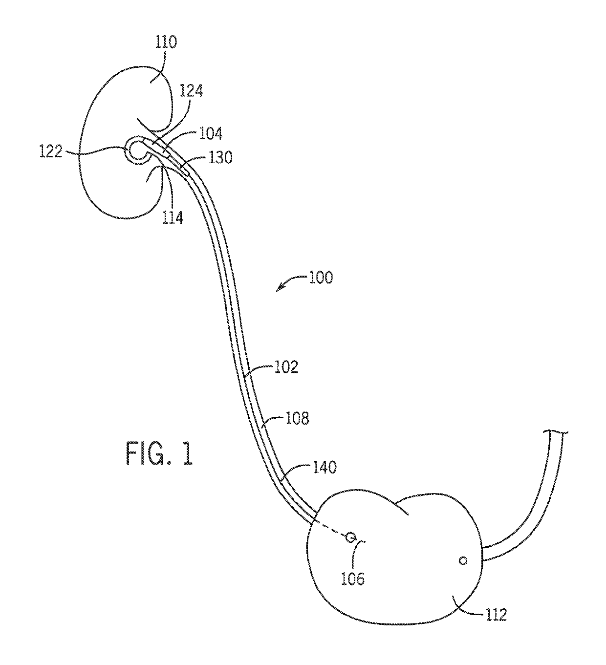 System and method for use of flexible anti-reflux ureteral stent