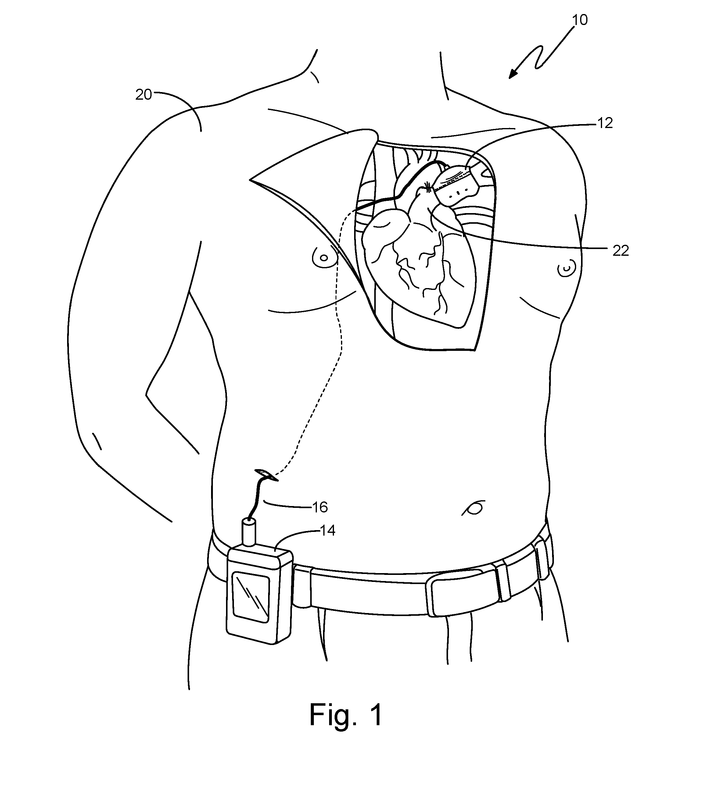 Pulmonary Arterial Hypertension Treatment Devices and Related Systems and Methods