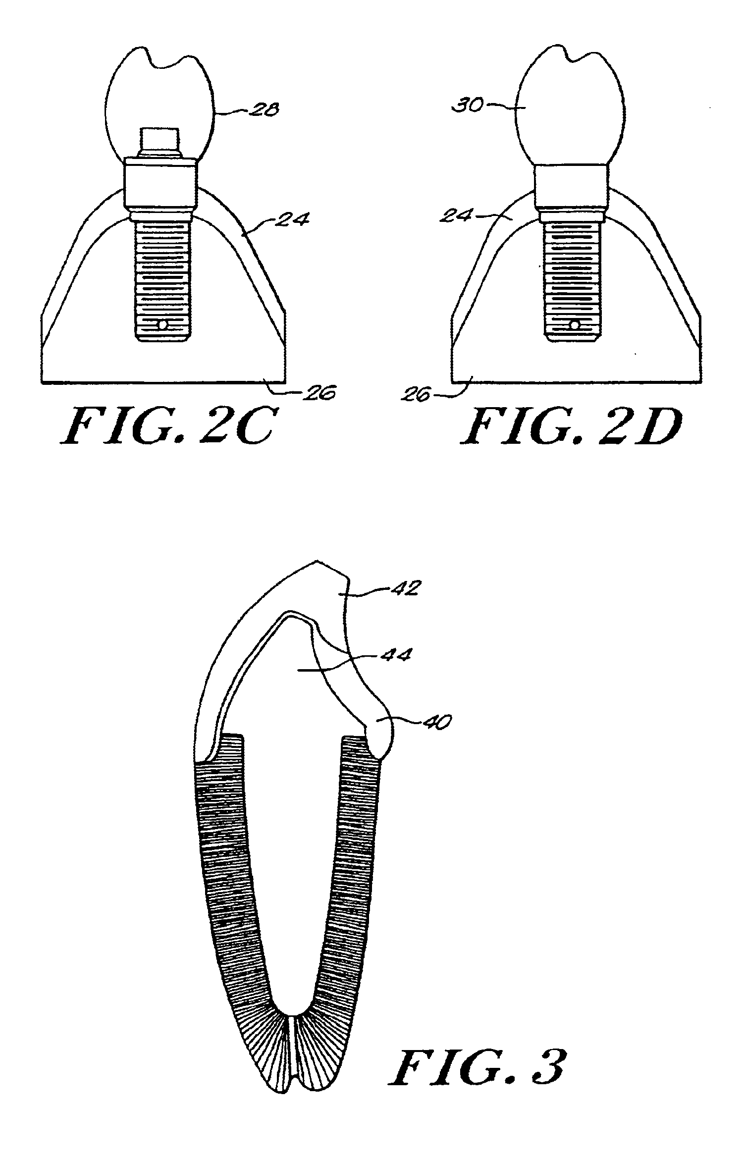 Method for fabricating endodontic, orthodontic, and direct restorations having infused ceramic network