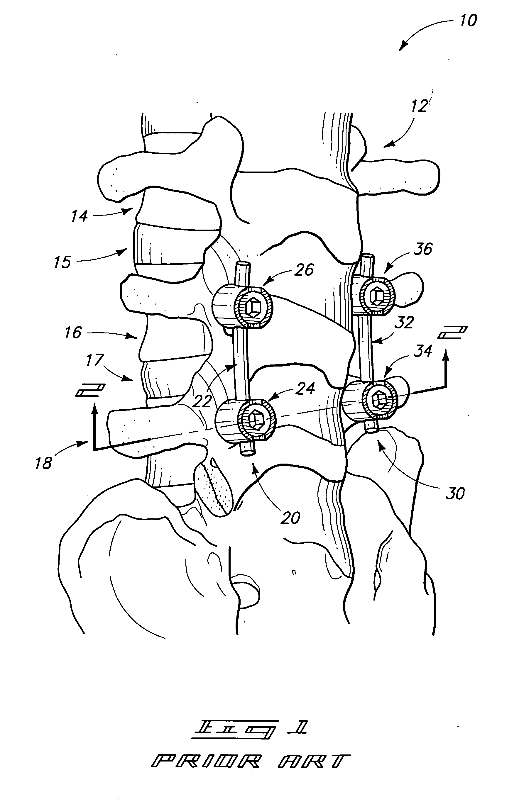 Screws configured to engage bones, and methods of attaching implants to skeletal regions