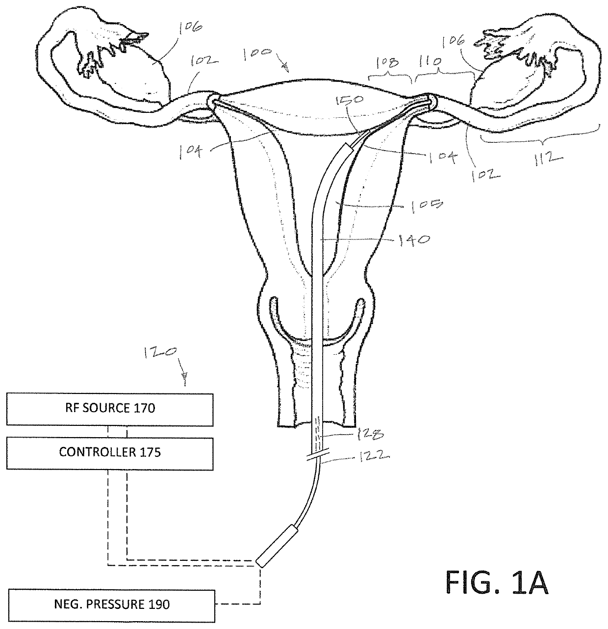 Systems and methods for permanent female contraception