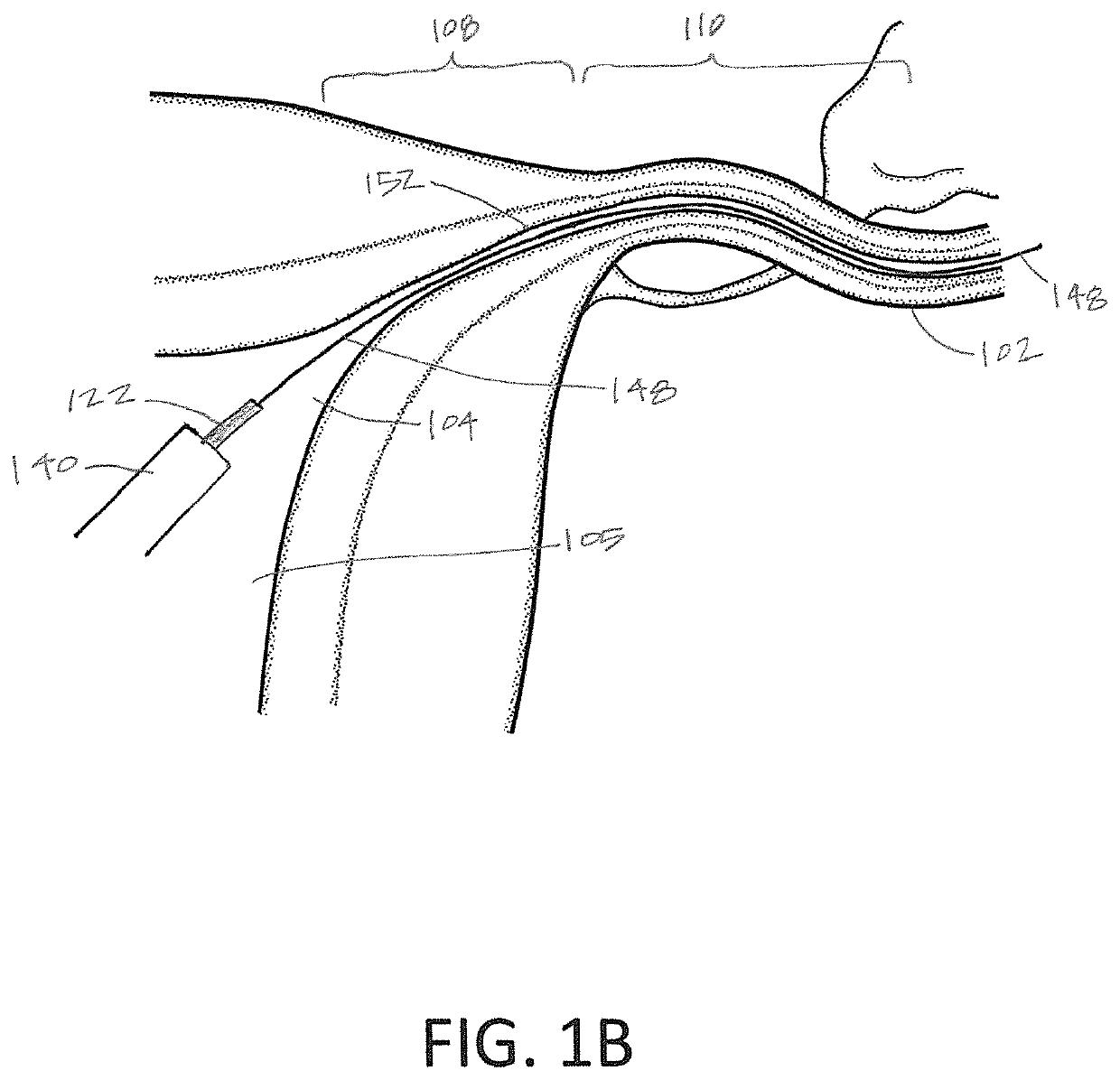 Systems and methods for permanent female contraception