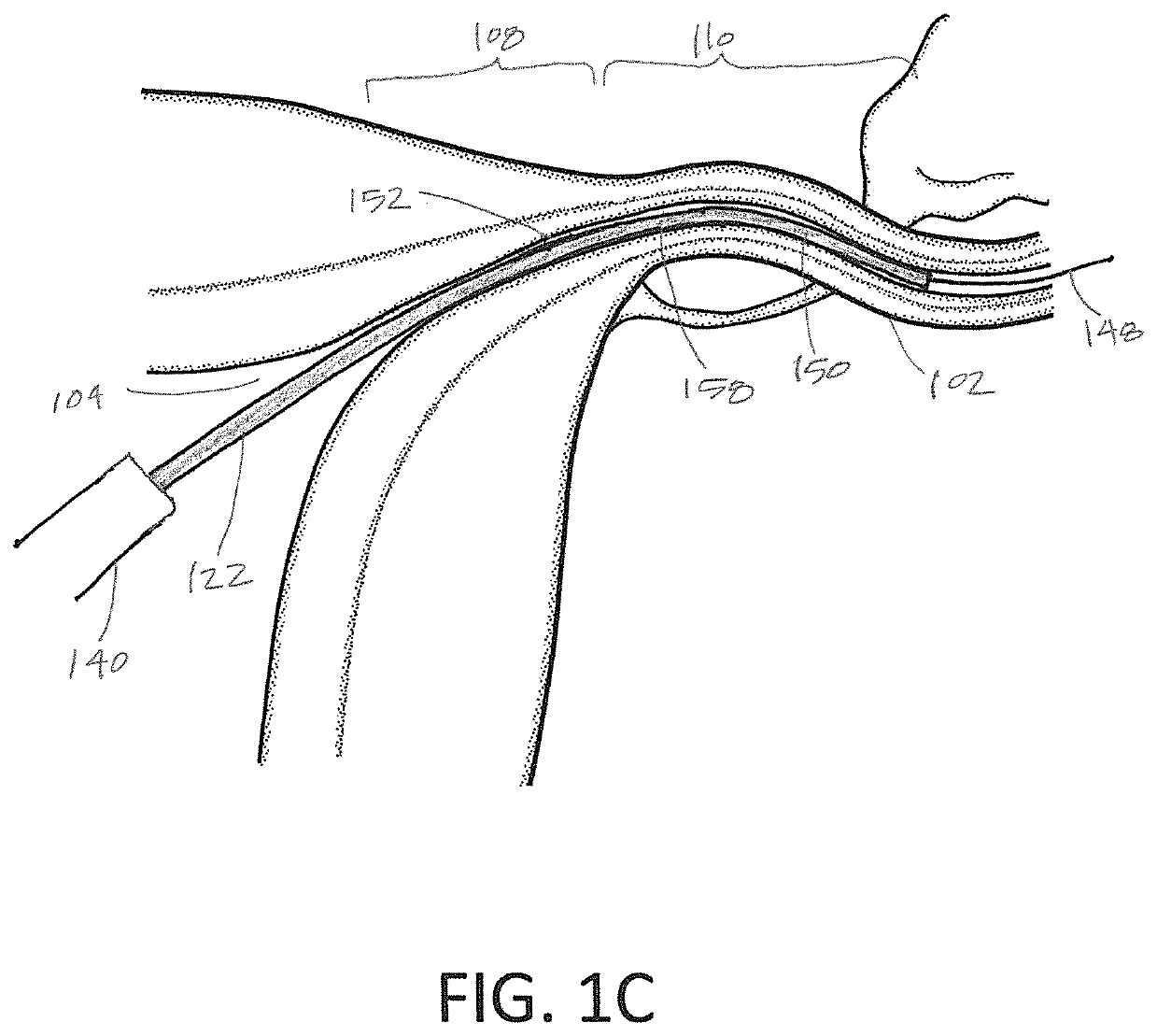 Systems and methods for permanent female contraception