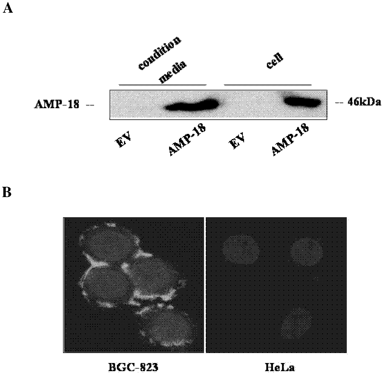 Application of ligand antrum mucosal protein-18(AMP-18) of laminin receptor in treatment of tumor