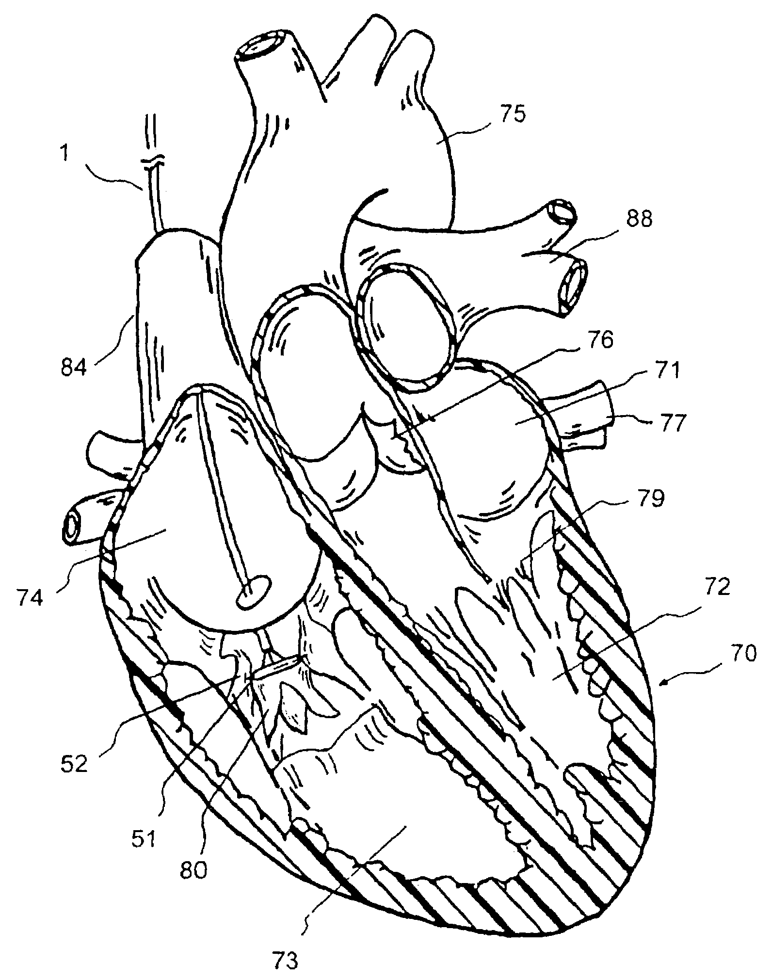 Methods for treating and repairing mitral valve annulus