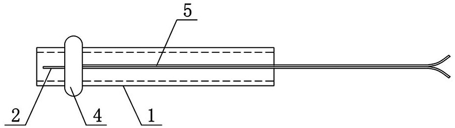 Expansion device for colorectal obstruction