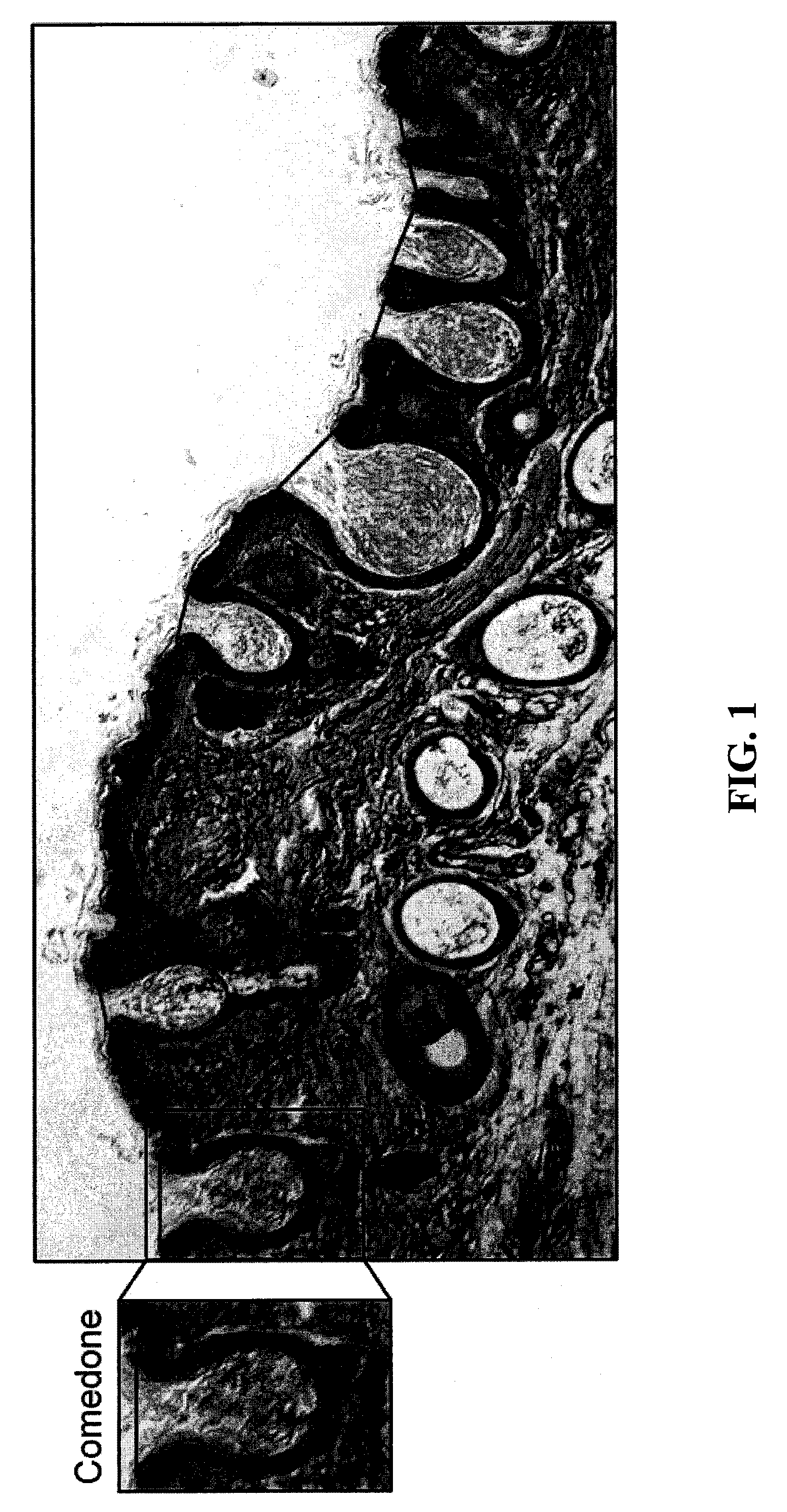 Compounds, compositions, kits and methods of use to orally and topically treat acne and other skin conditions by administering a 19-nor containing vitamin d analog with or without a retinoid