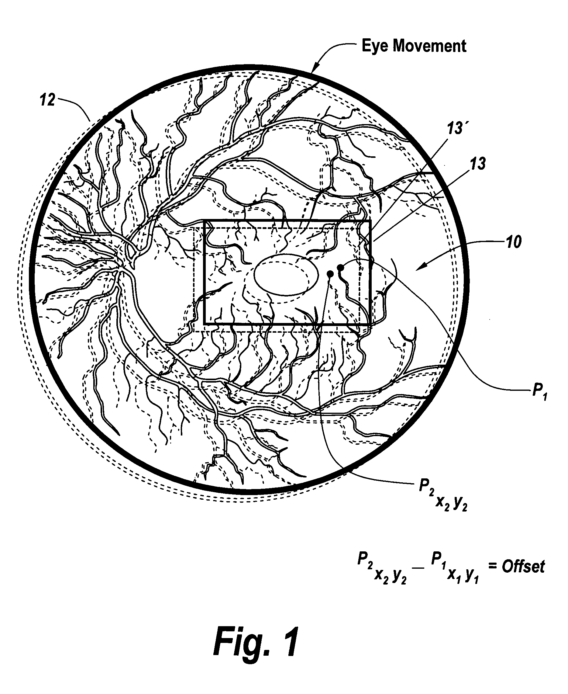 Region based vision tracking system for imaging of the eye for use in optical coherence tomography