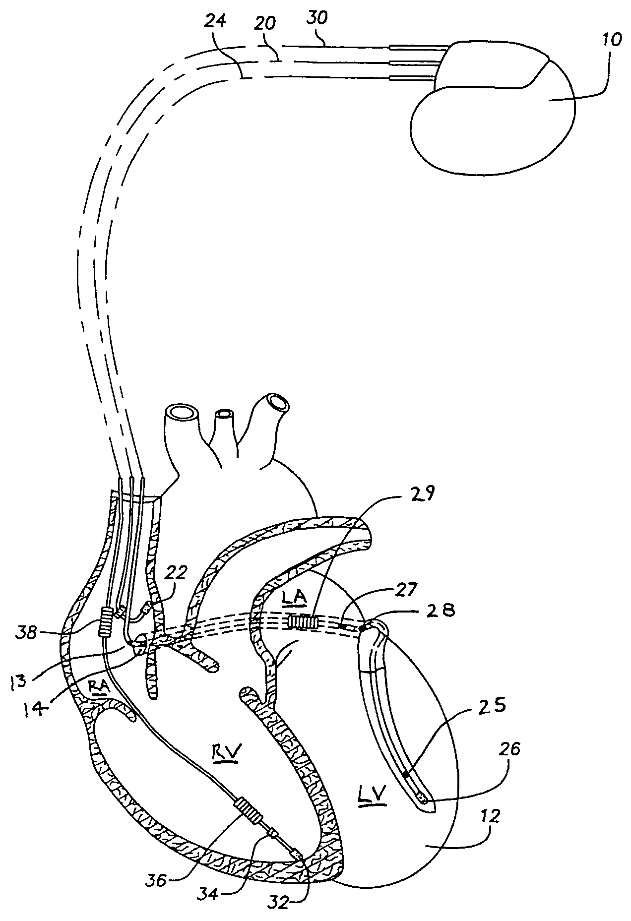 Anti-tachycardia pacing methods and devices