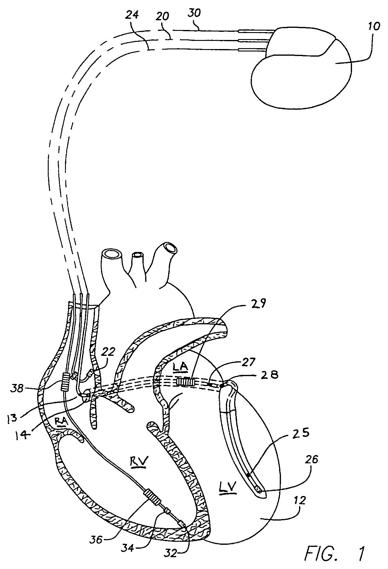 Anti-tachycardia pacing methods and devices