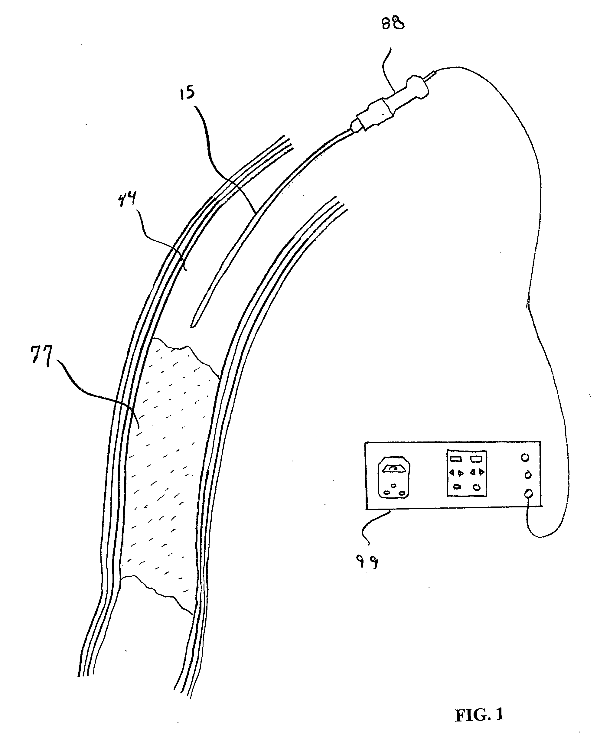Apparatus and method for an ultrasonic medical device to treat chronic total occlusions