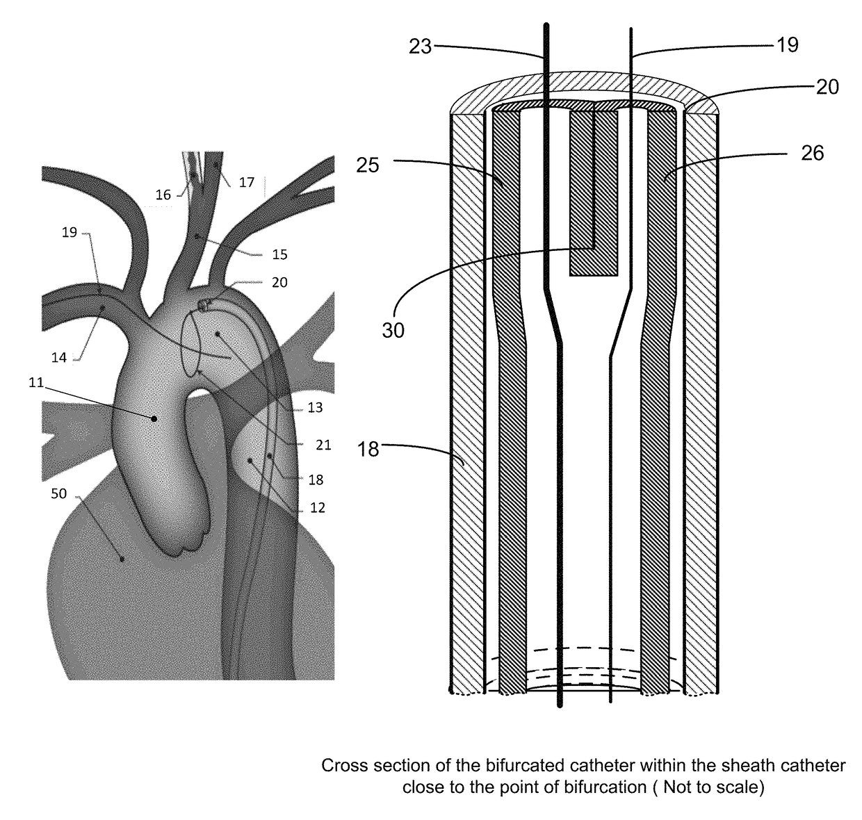 Apparatus and method for a bifurcated catheter for use in hostile aortic arches