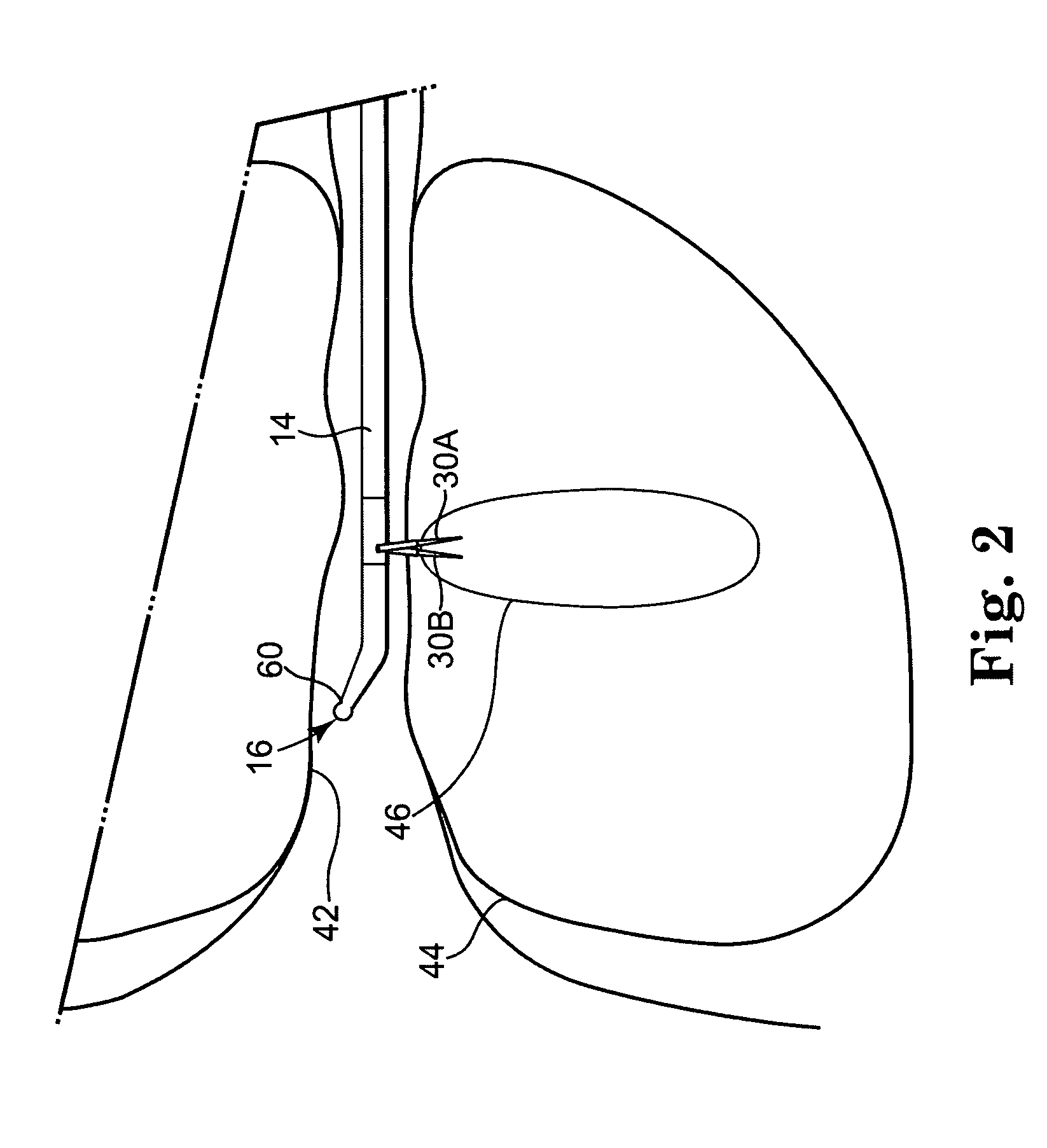 Transurethral needle ablation system with flexible catheter tip