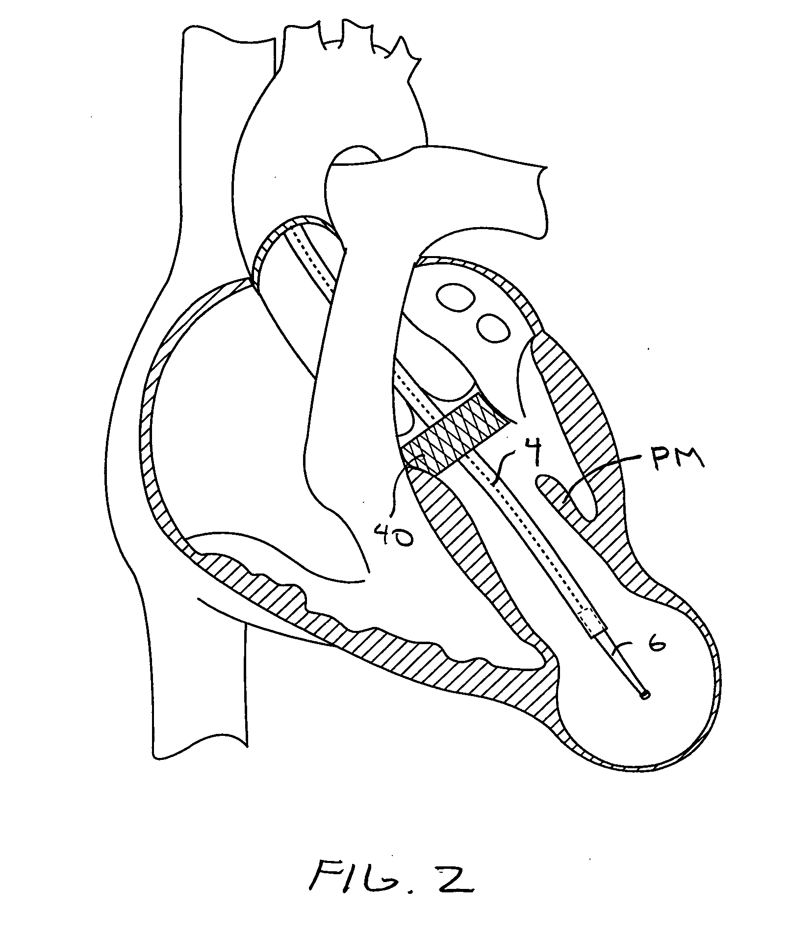 Methods and devices for altering blood flow through the left ventricle