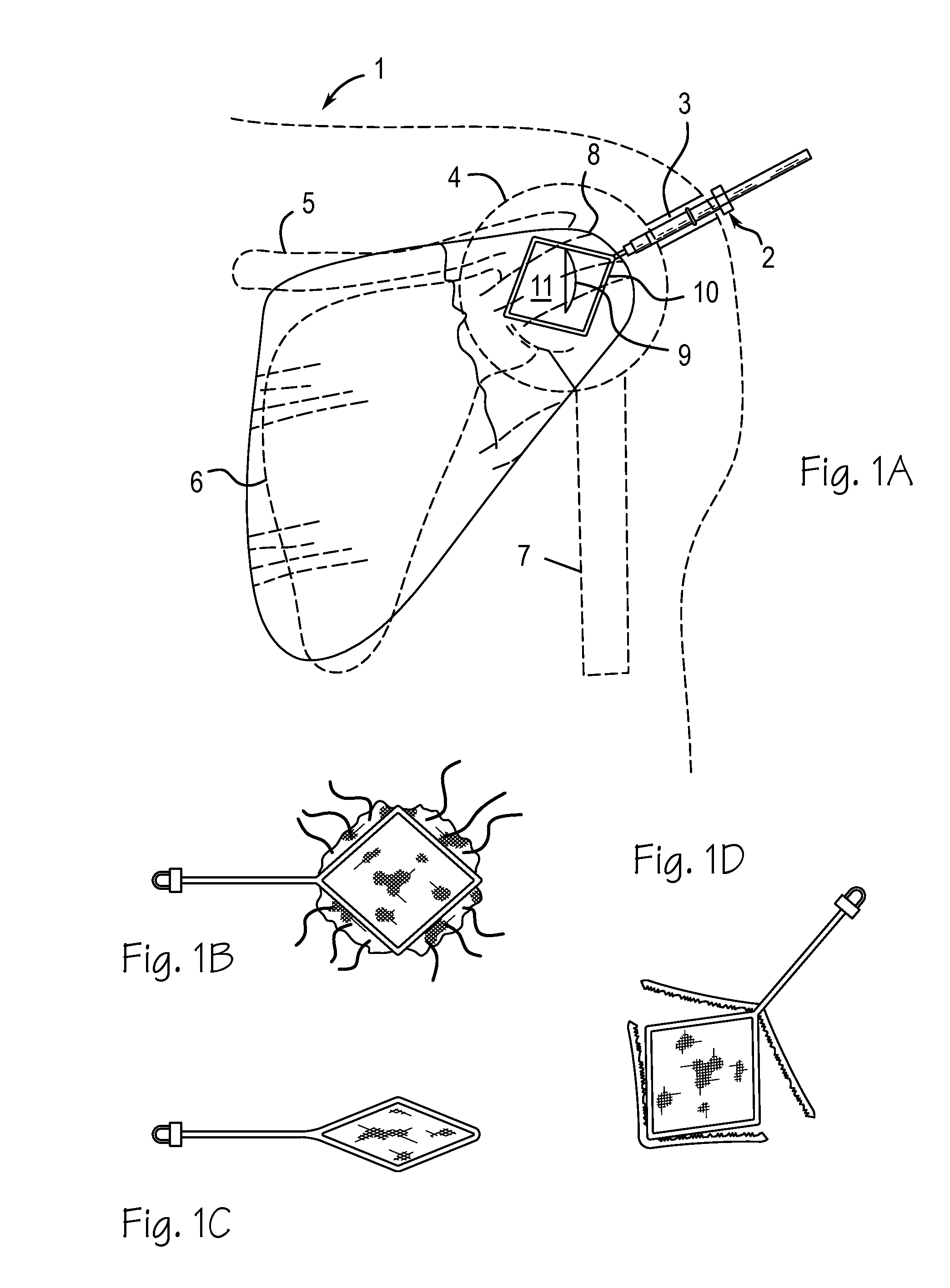 Method and Devices for Implantation of Biologic Constructs