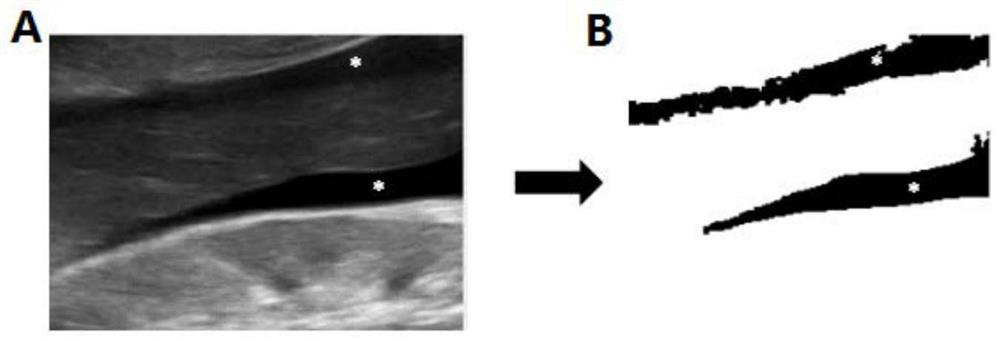 Automatic identification method for seroperitoneum B-mode ultrasound image