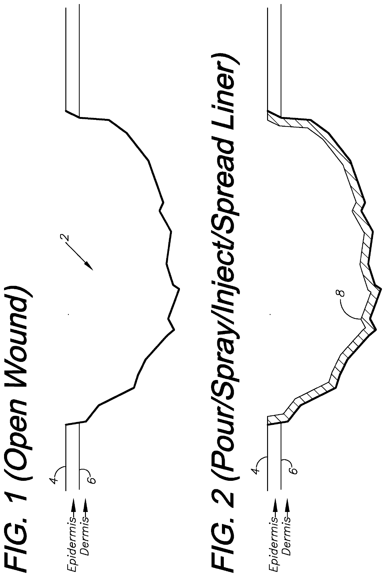 Wound treatment system and method